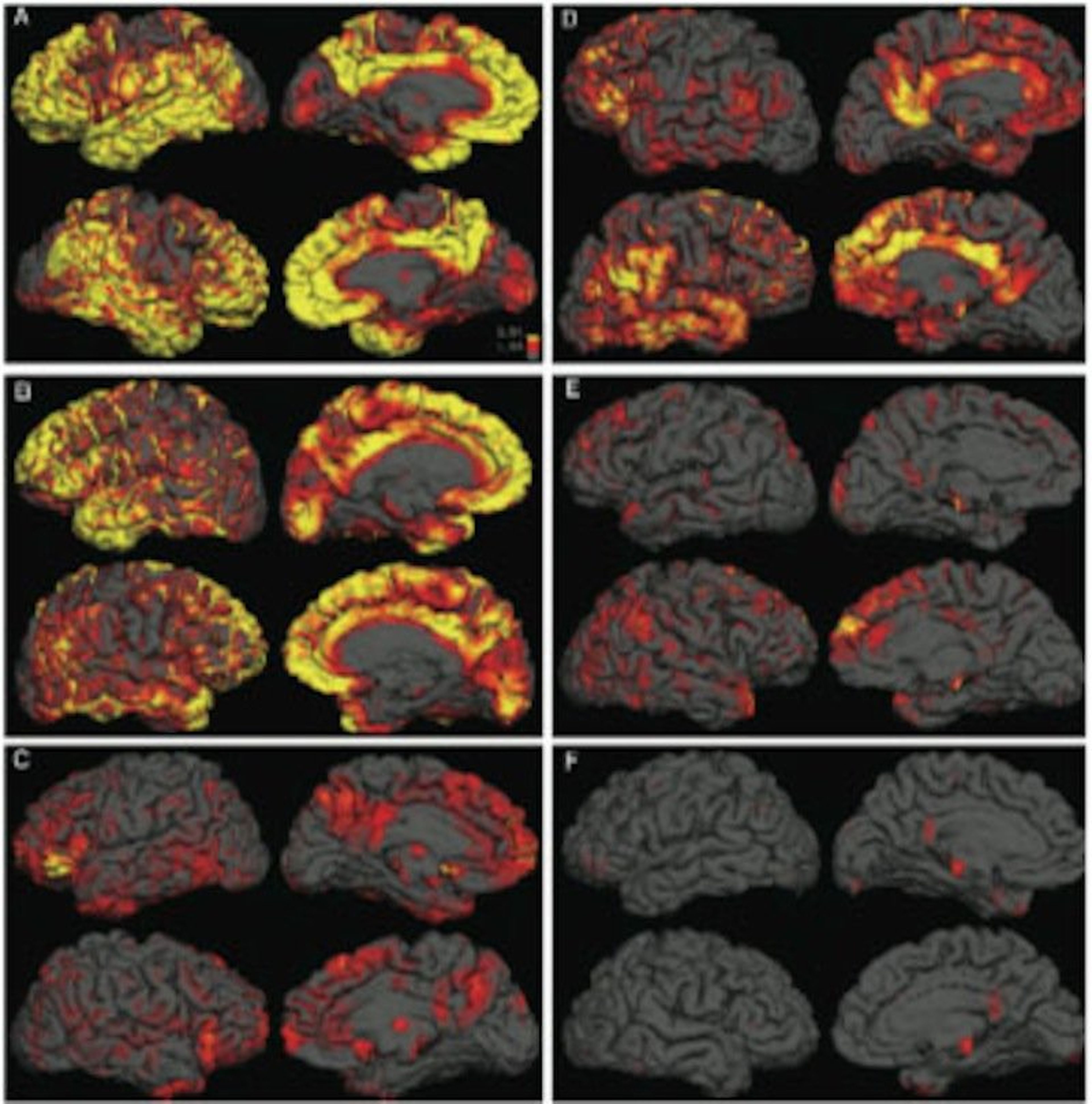 Placas almoides en tres cerebros de personas con Alzheimer (izquierda) y tres cerebros de individuos del grupo de control (derecha)