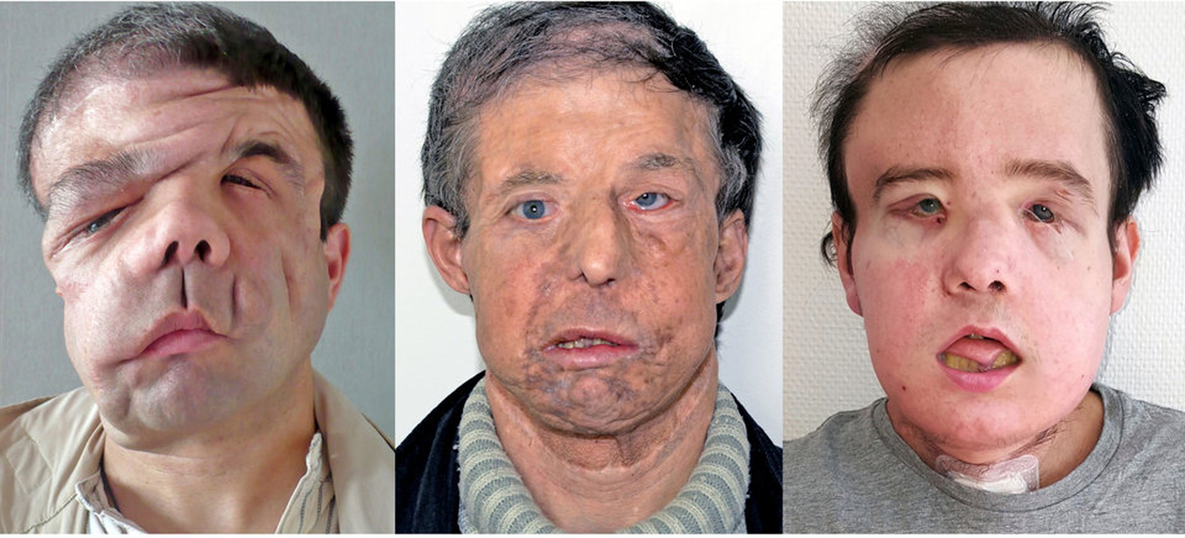 Los medios franceses se refieren a Hamon, quien recibió un trasplante de cara en 2010 y otro este año, como el "hombre con tres caras".