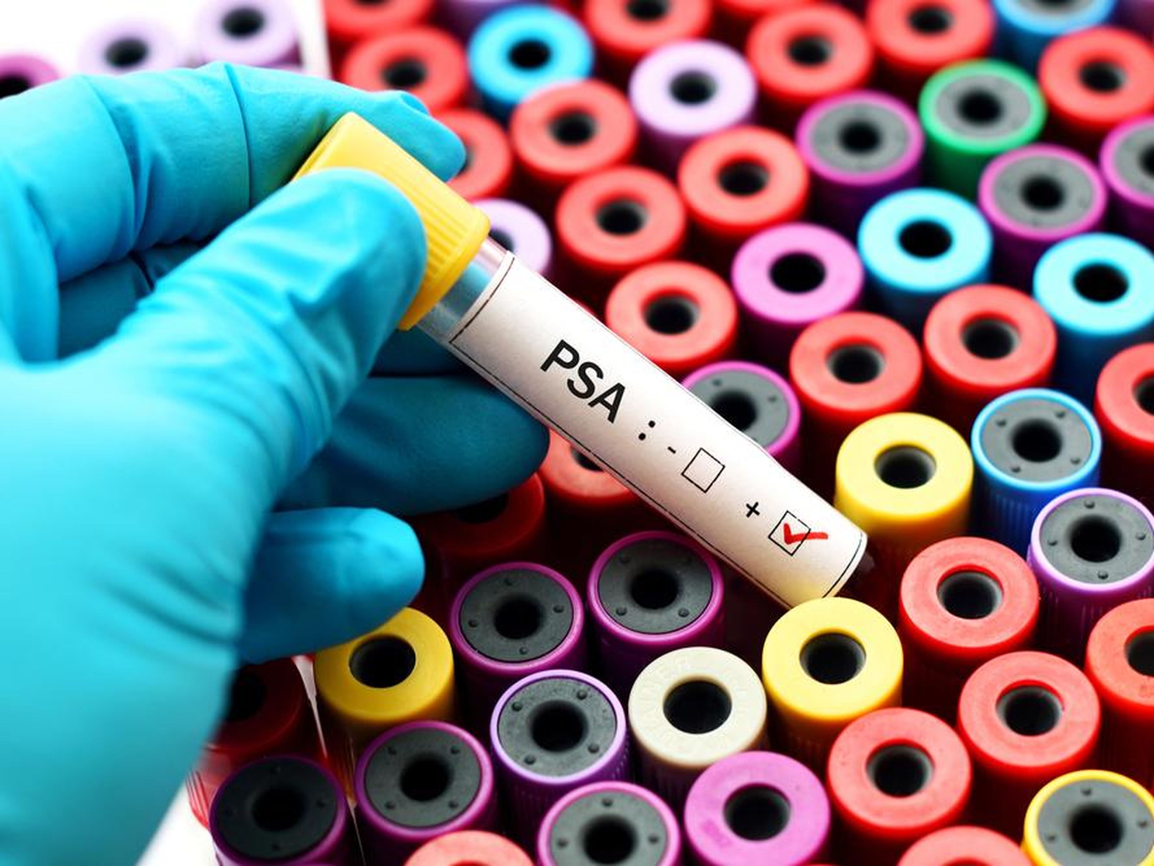 Una prueba de PSA (antígeno prostático específico) puede detectar el cáncer de próstata.