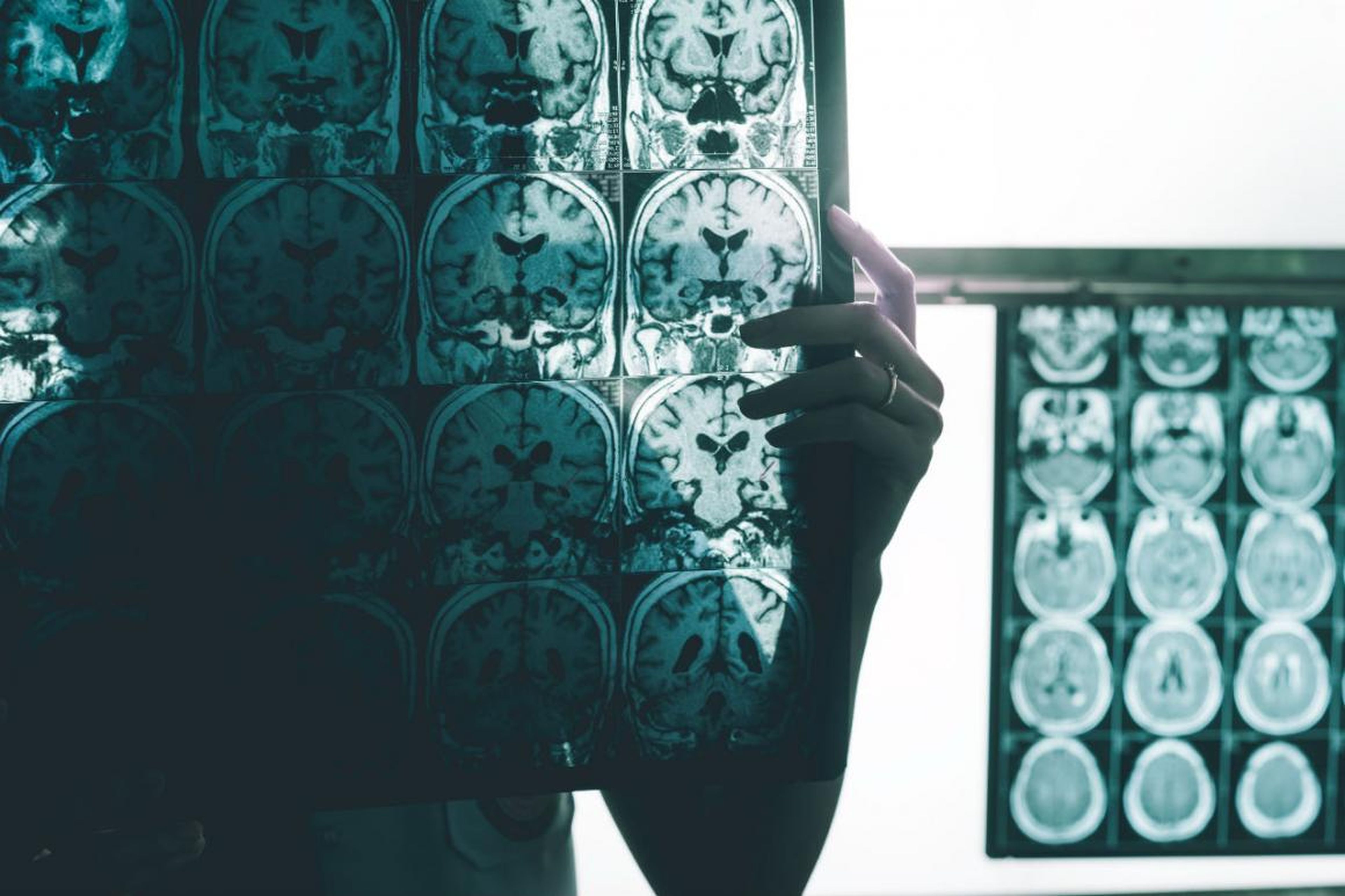 An Alzheimer's brain scan.