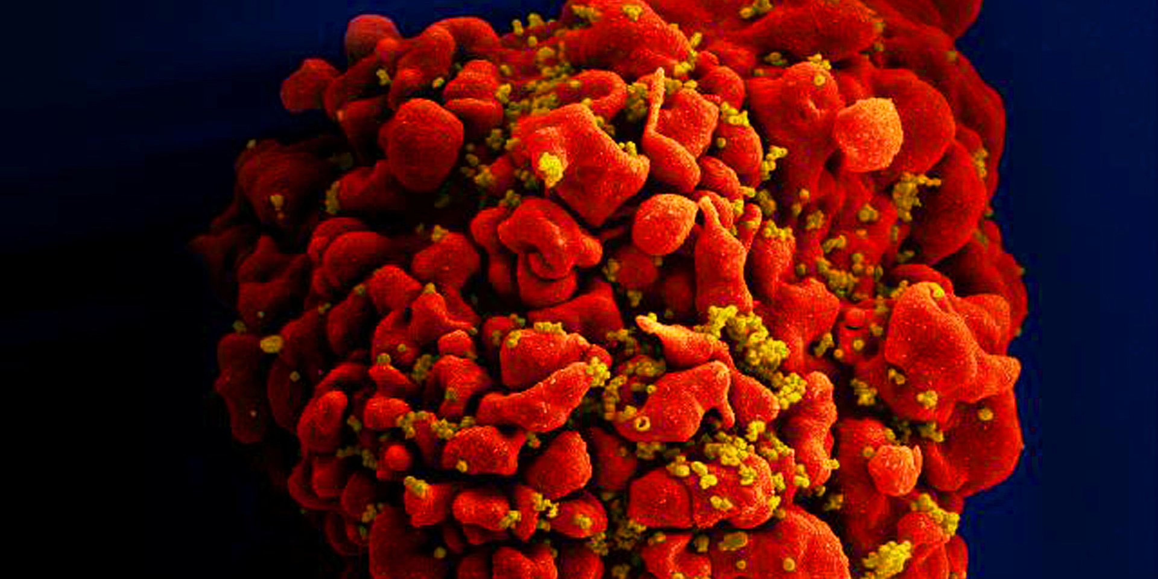 Una célula infectada por el virus del VIH