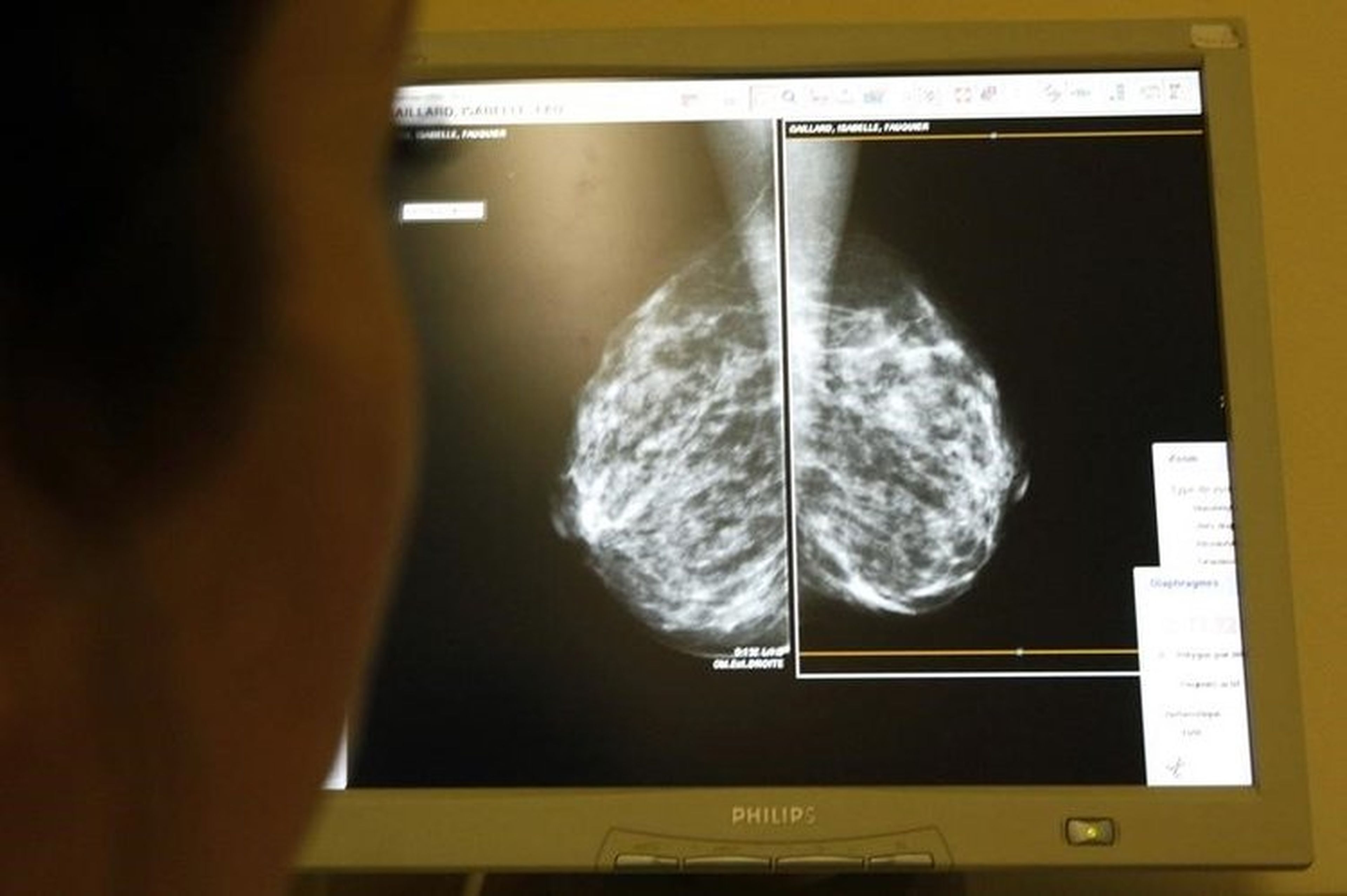 La IA fue capaz de detectar anomalías en las mamografías de los pacientes que de otra manera no se habrían encontrado.