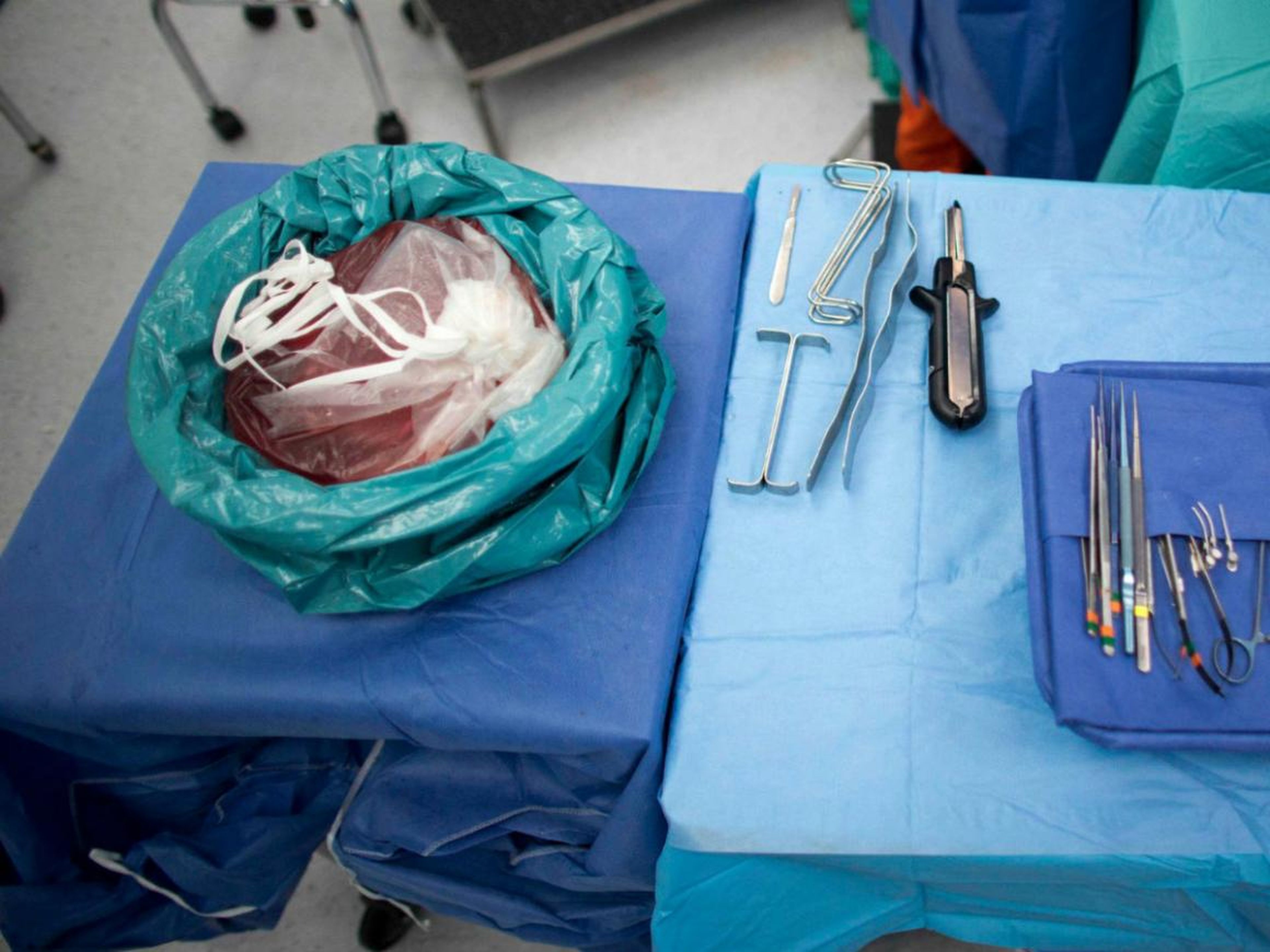 Trozo de hígado sano extraído de una persona en una bolsa antes de ser trasplantado.