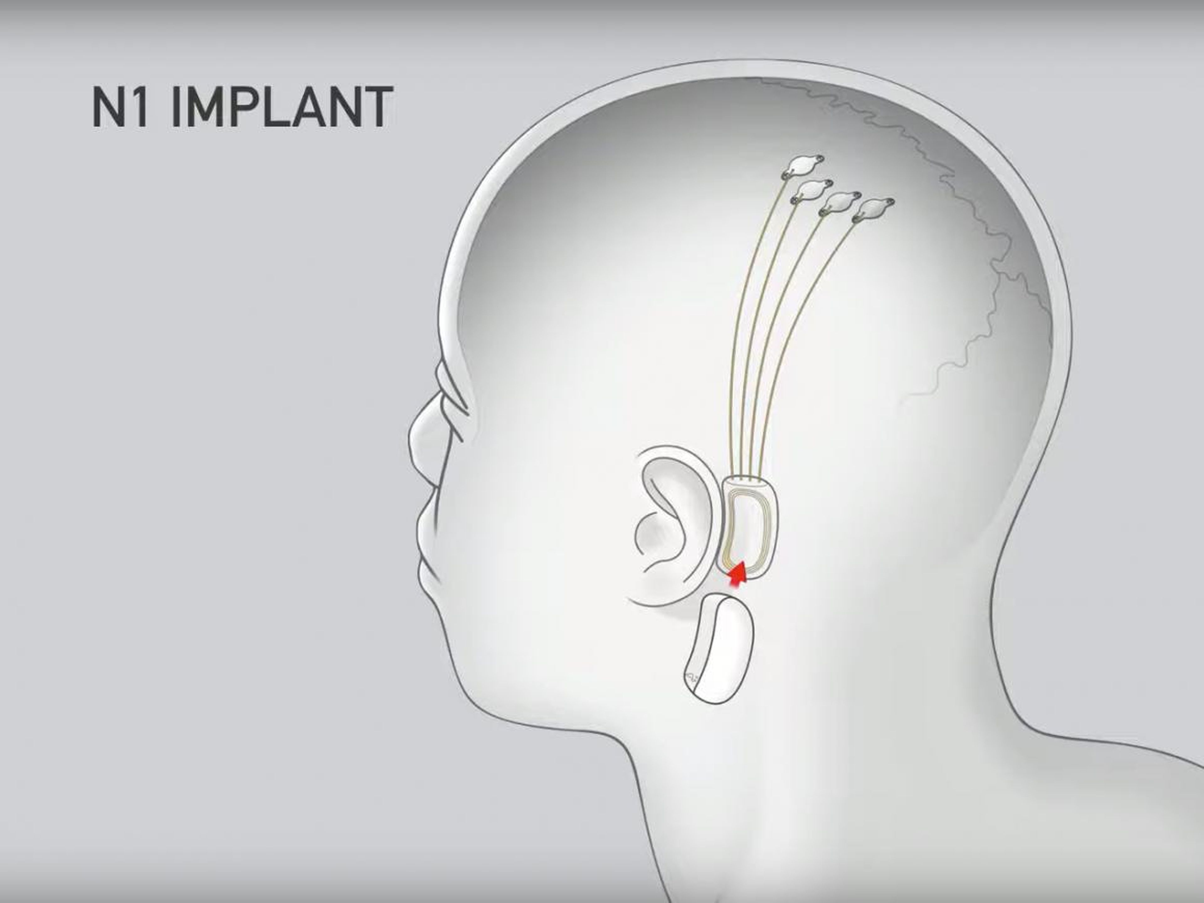 El chip se coloca detrás de la oreja, mientras que los electrodos se insertan en el cerebro.