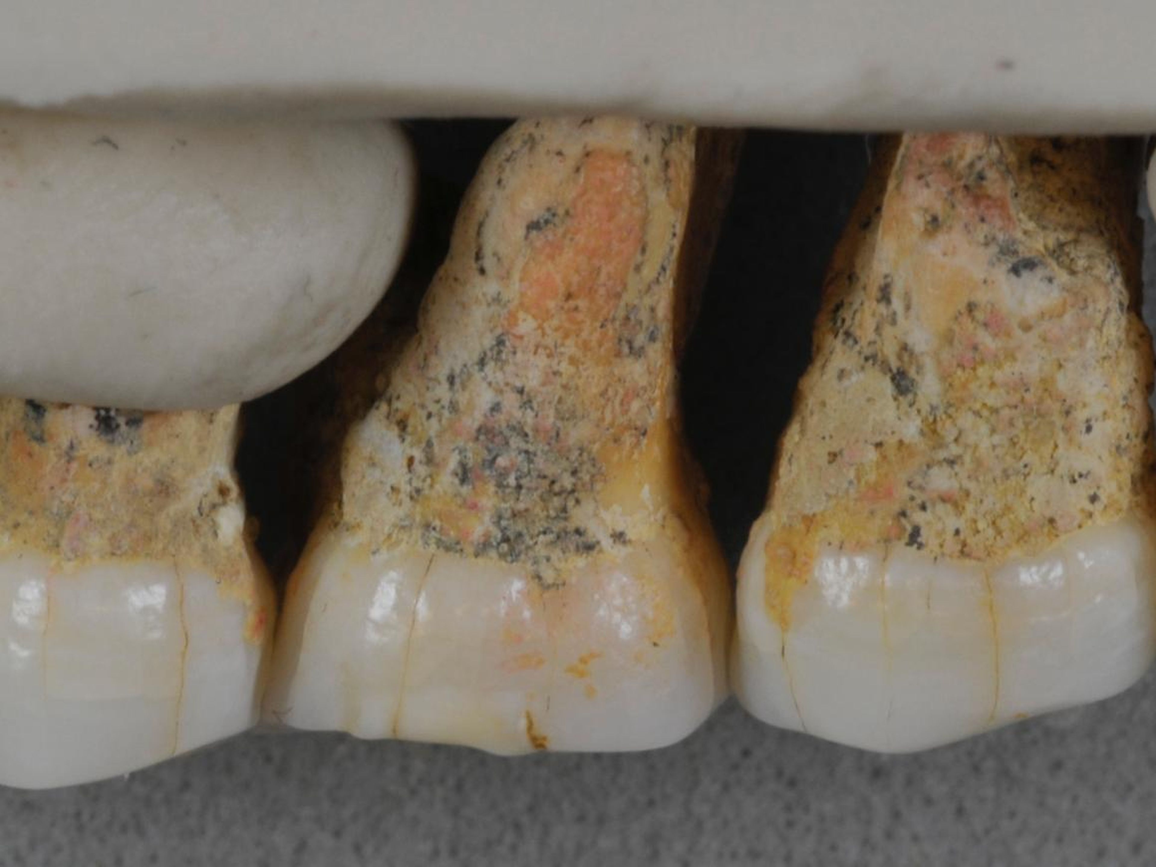 The right upper teeth of the individual known as CCH6, of the new species Homo luzonensis.