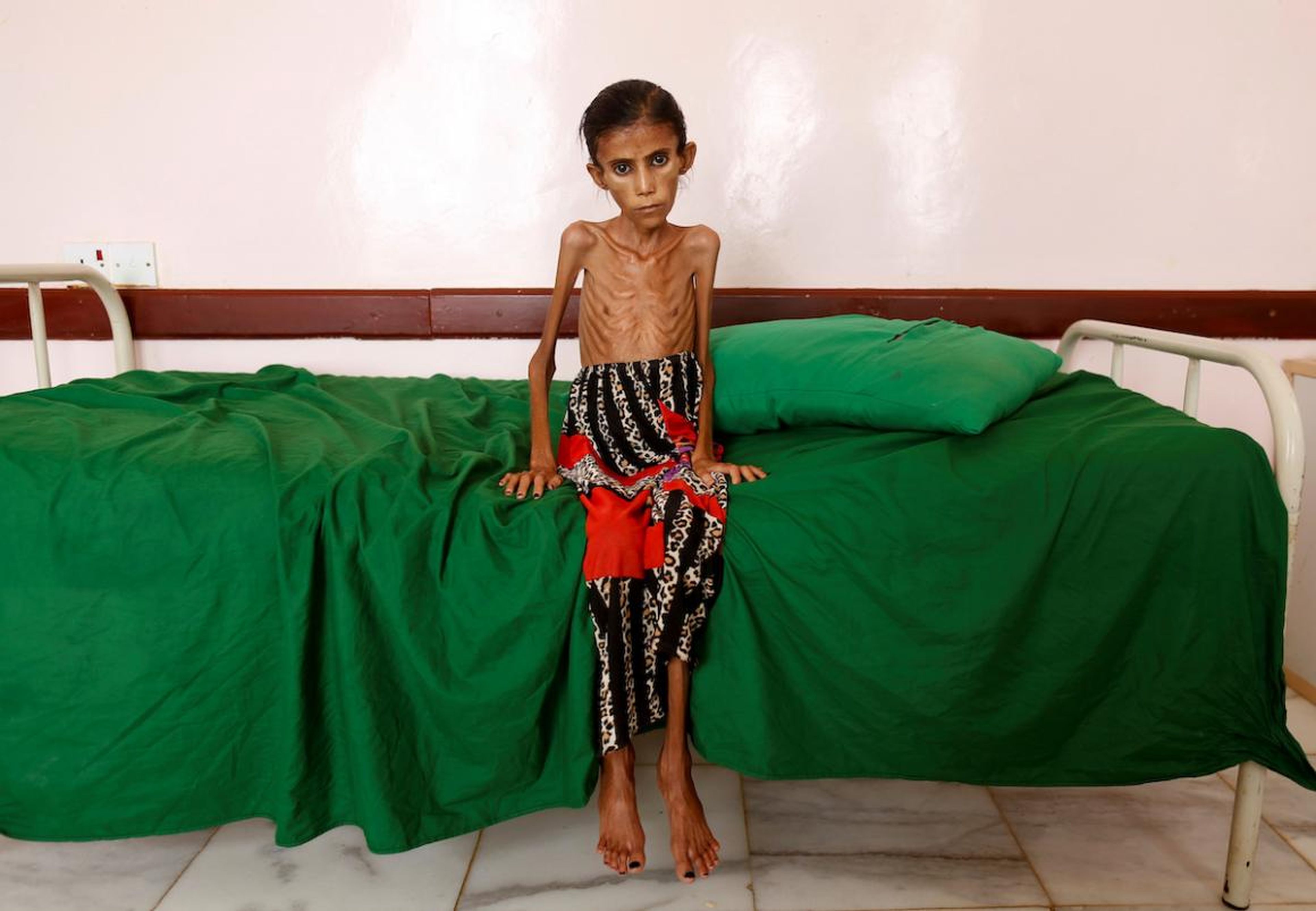 Fatima Ibrahim Hadi, 12, who is malnourished and weighs just 22 pounds, sits on a bed at a clinic in Aslam, in the northwestern province of Hajjah, Yemen, on February 17.