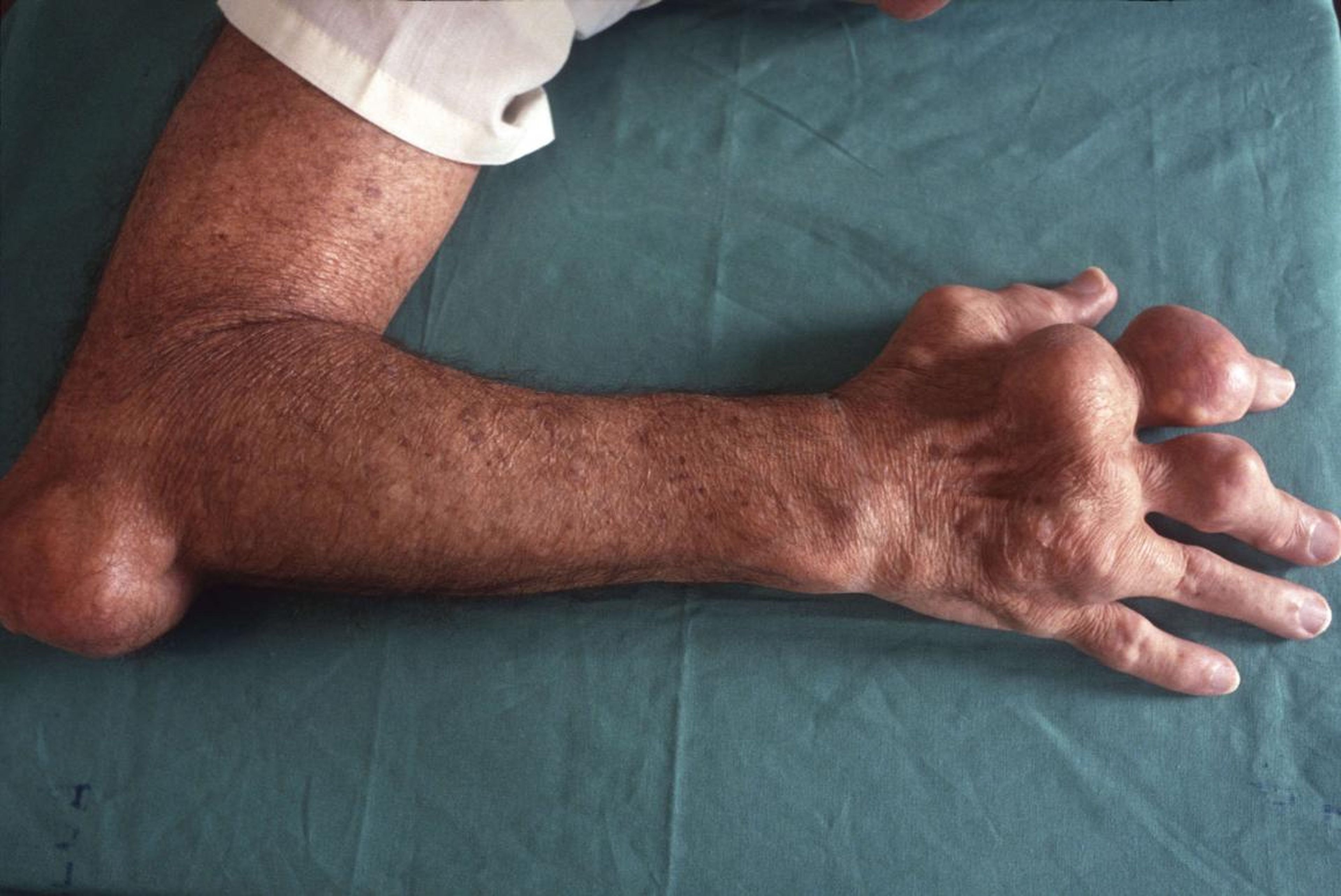 Deformación corporal causada por gota (también conocida como podagra cuando afecta al dedo gordo del pie).