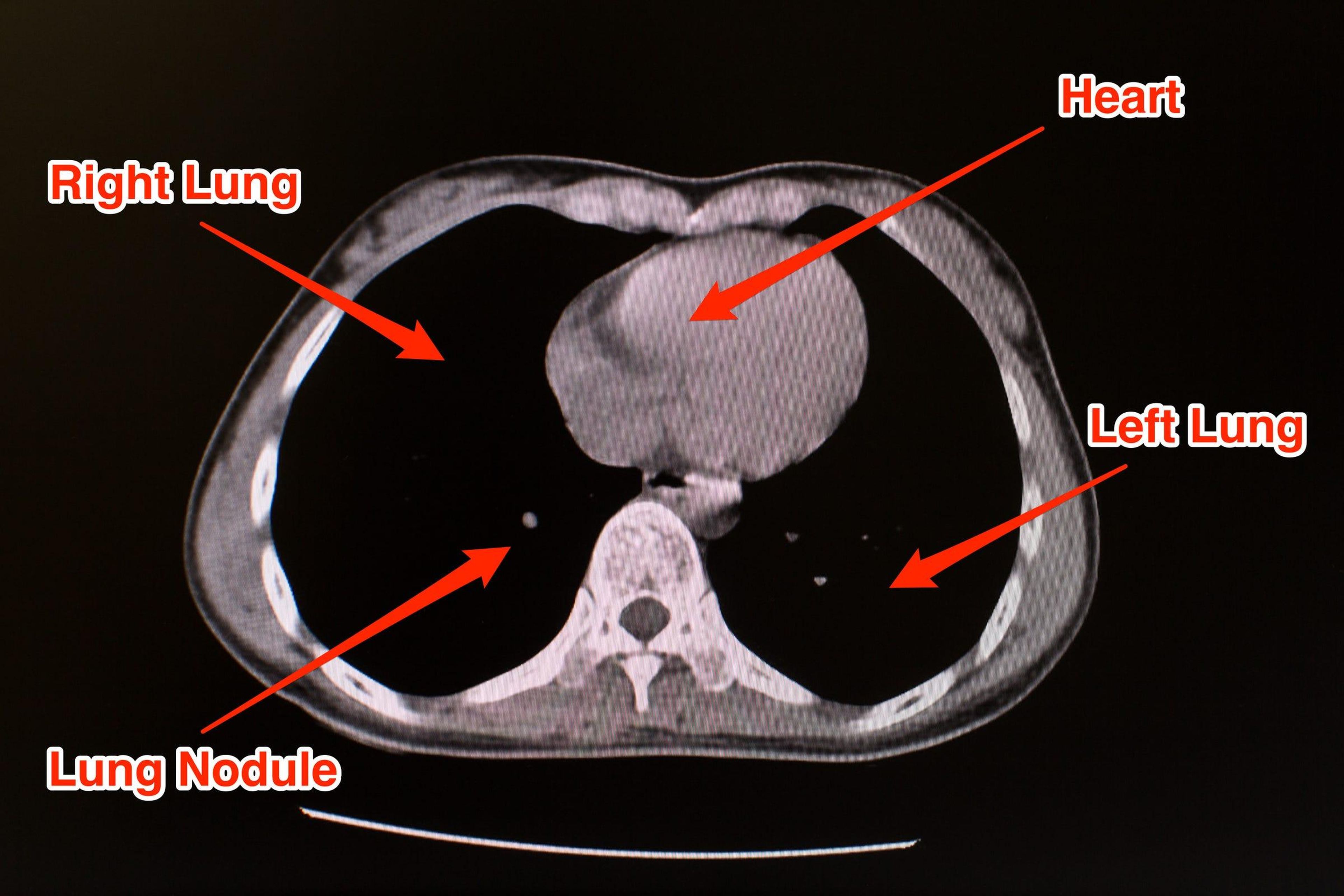 Normal lungs should appear black on a CT scan.