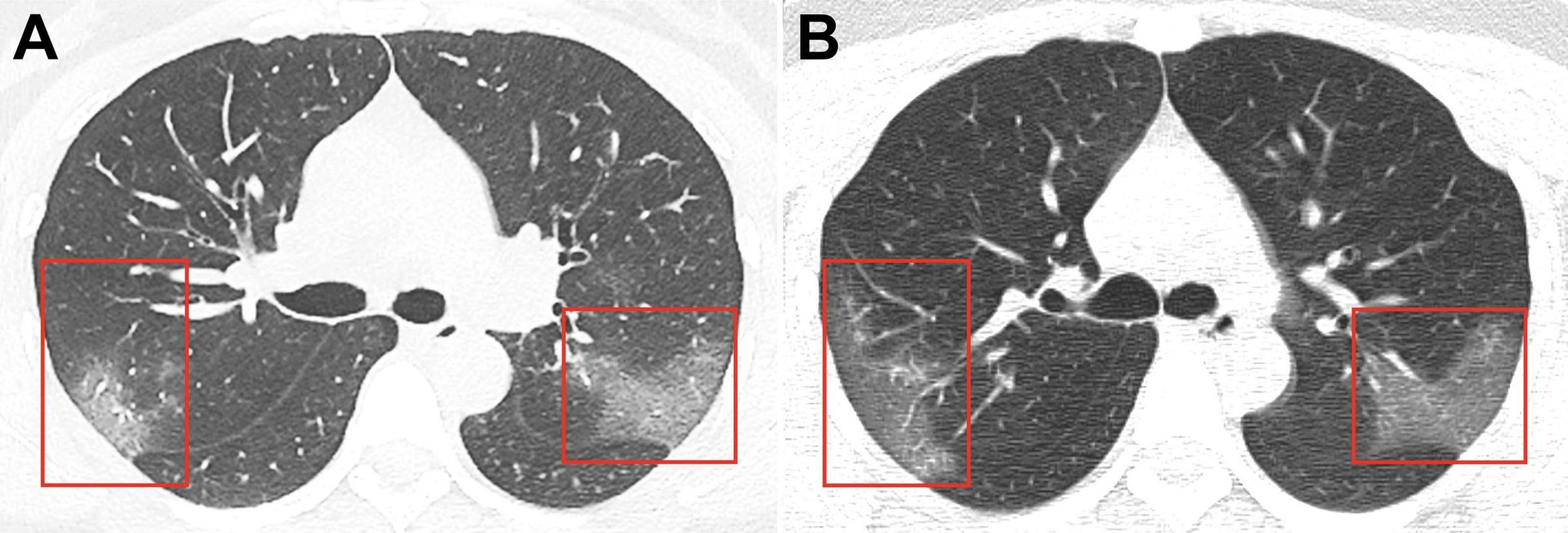 En un TAC de los pulmones de un paciente con COVID-19, los parches blancos de "opacidad de vidrio esmerilado" indican que el líquido está llenando los pulmones.