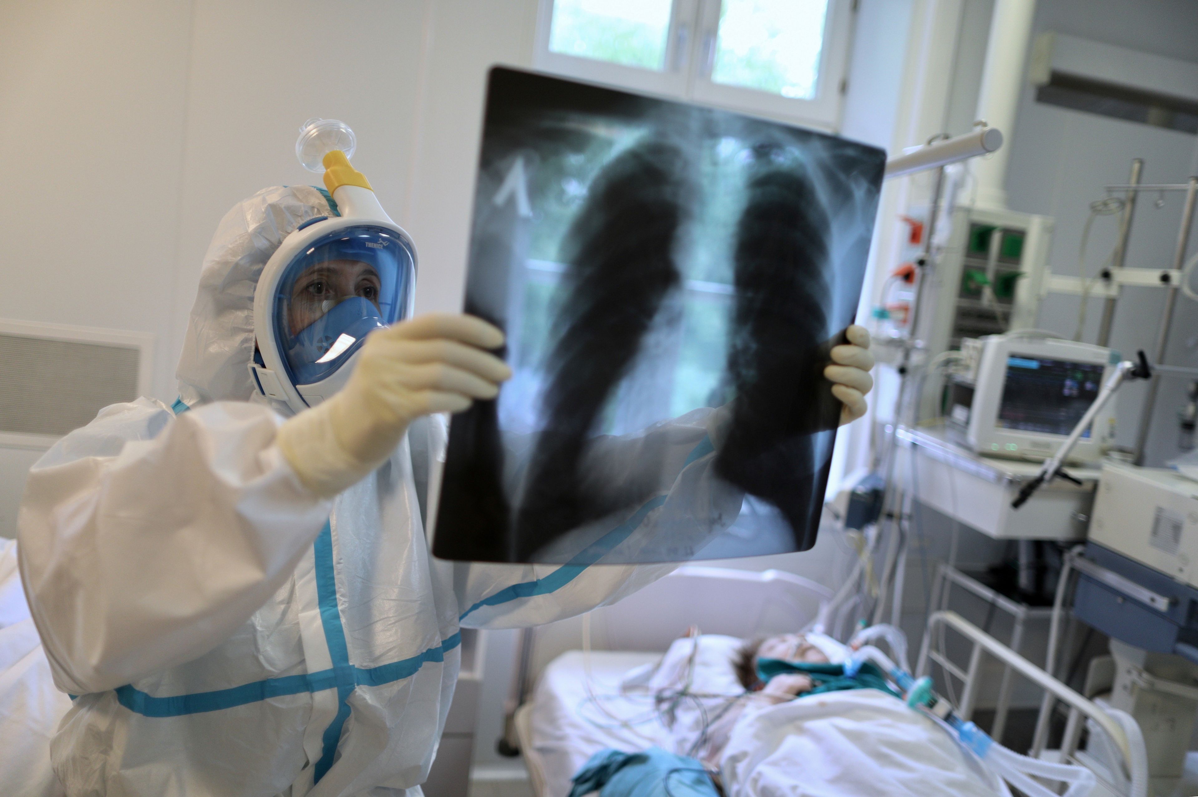 Una radiografía de un paciente con COVID-19.