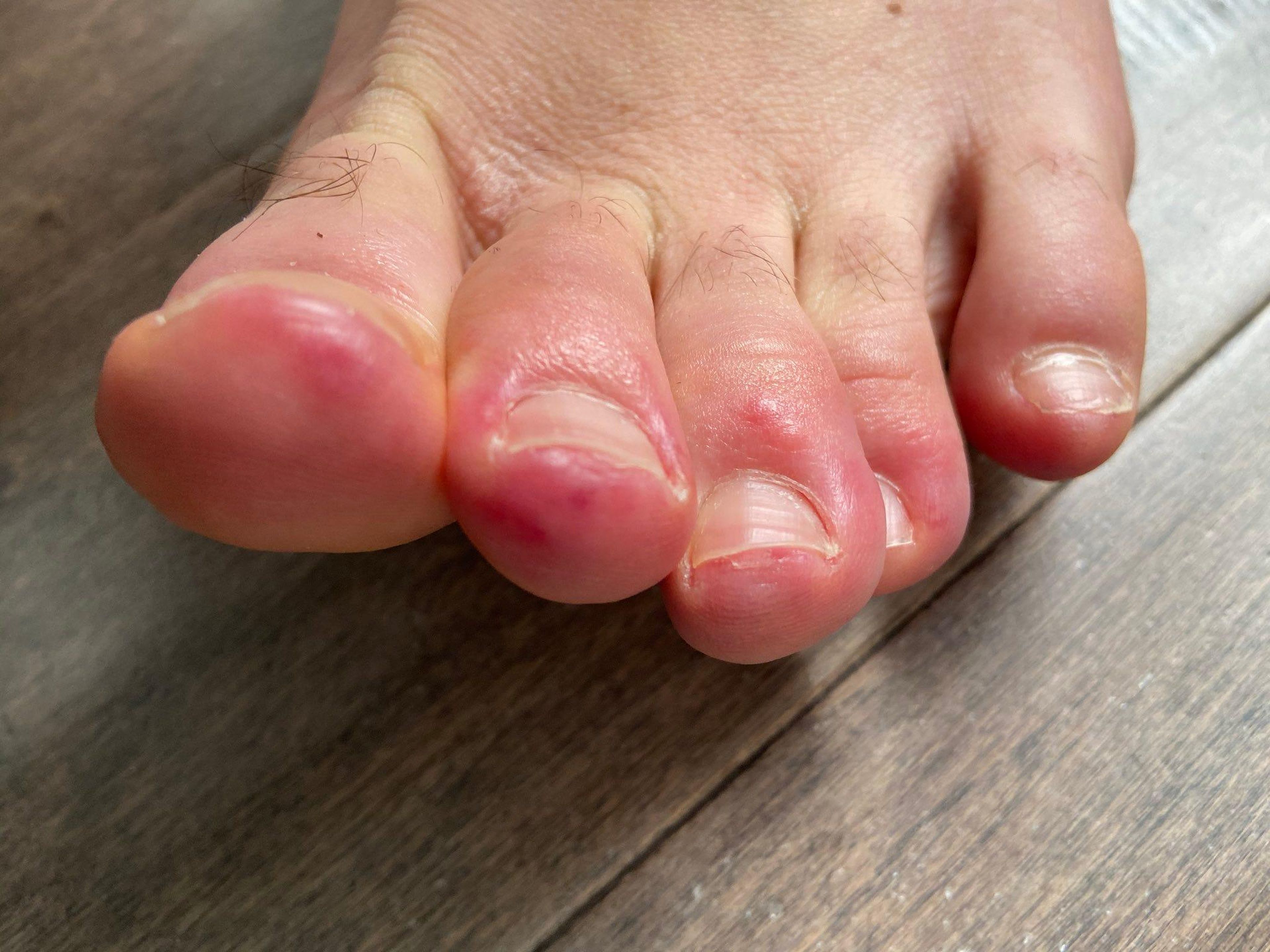 Los dermatólogos han reportado haber visto a pacientes con coronavirus con los dedos de los pies morados e hinchados — lo que la comunidad médica ahora llama "dedos de los pies COVID".