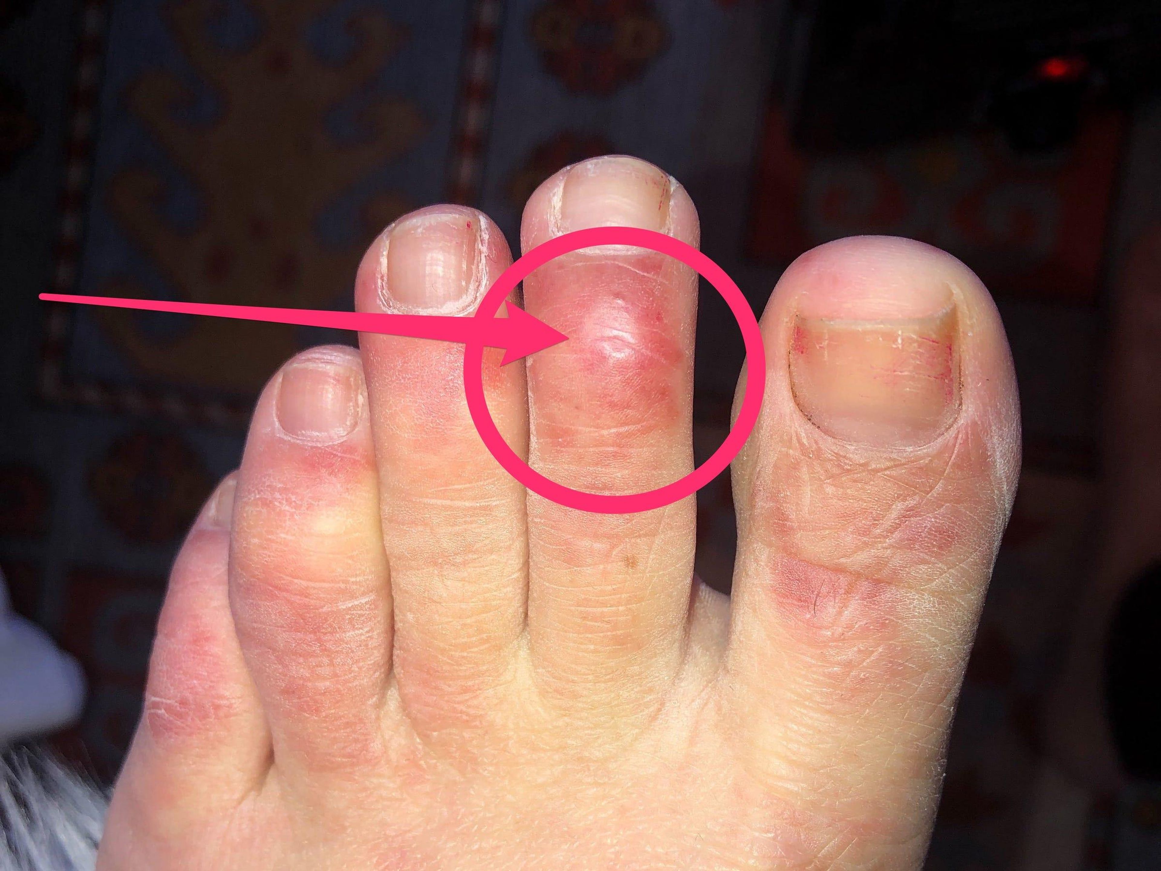 Una nueva investigación ofrece detalles sobre el misterioso síntoma en los dedos de los pies en relación con el COVID-19.