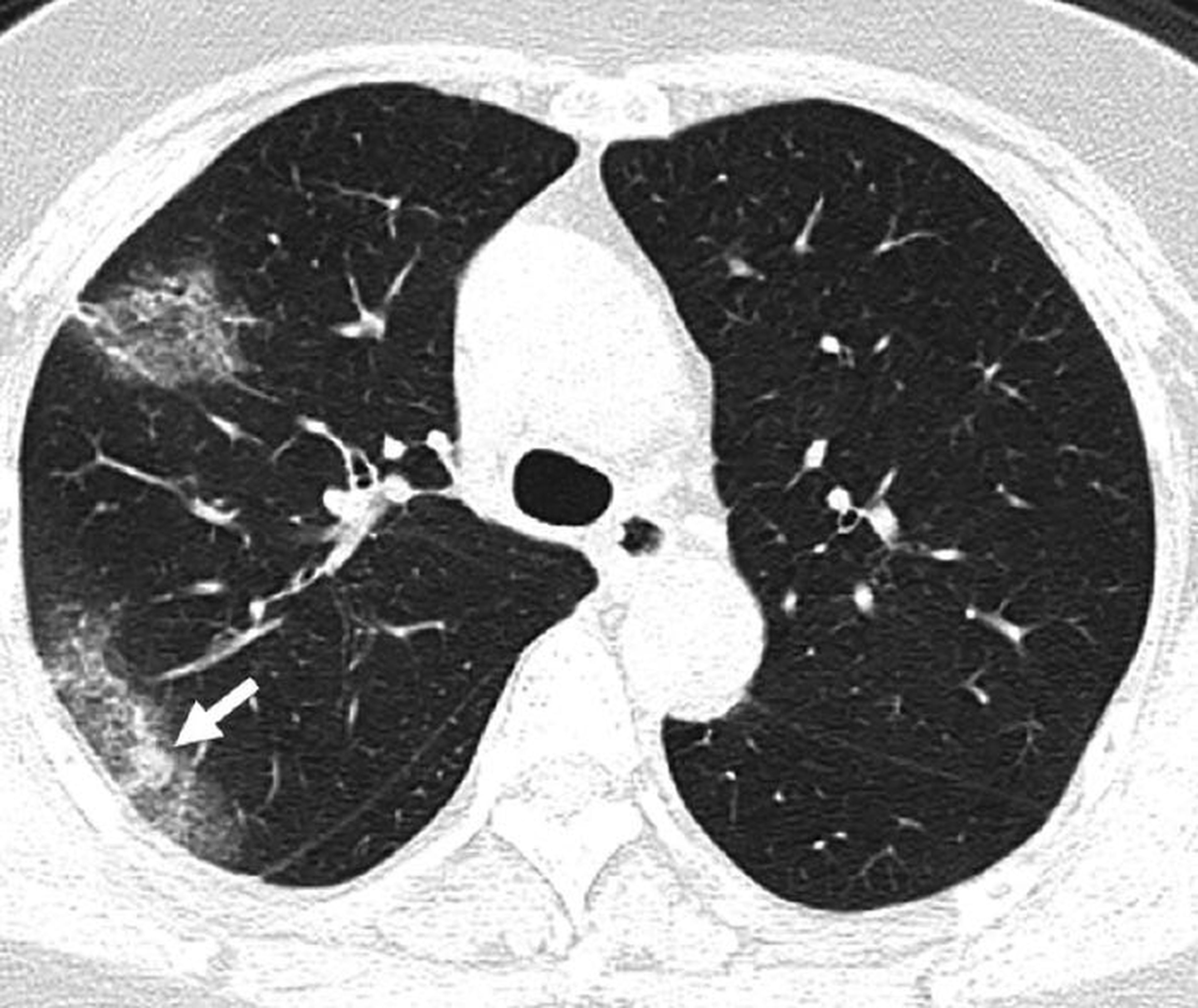 Un escáner muestra la apariencia de "vidrio esmerilado" de una infección severa de COVID-19, provocada por el líquido en los pulmones.
