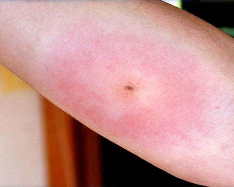 7 picaduras de insectos que indican que deberías ir al médico