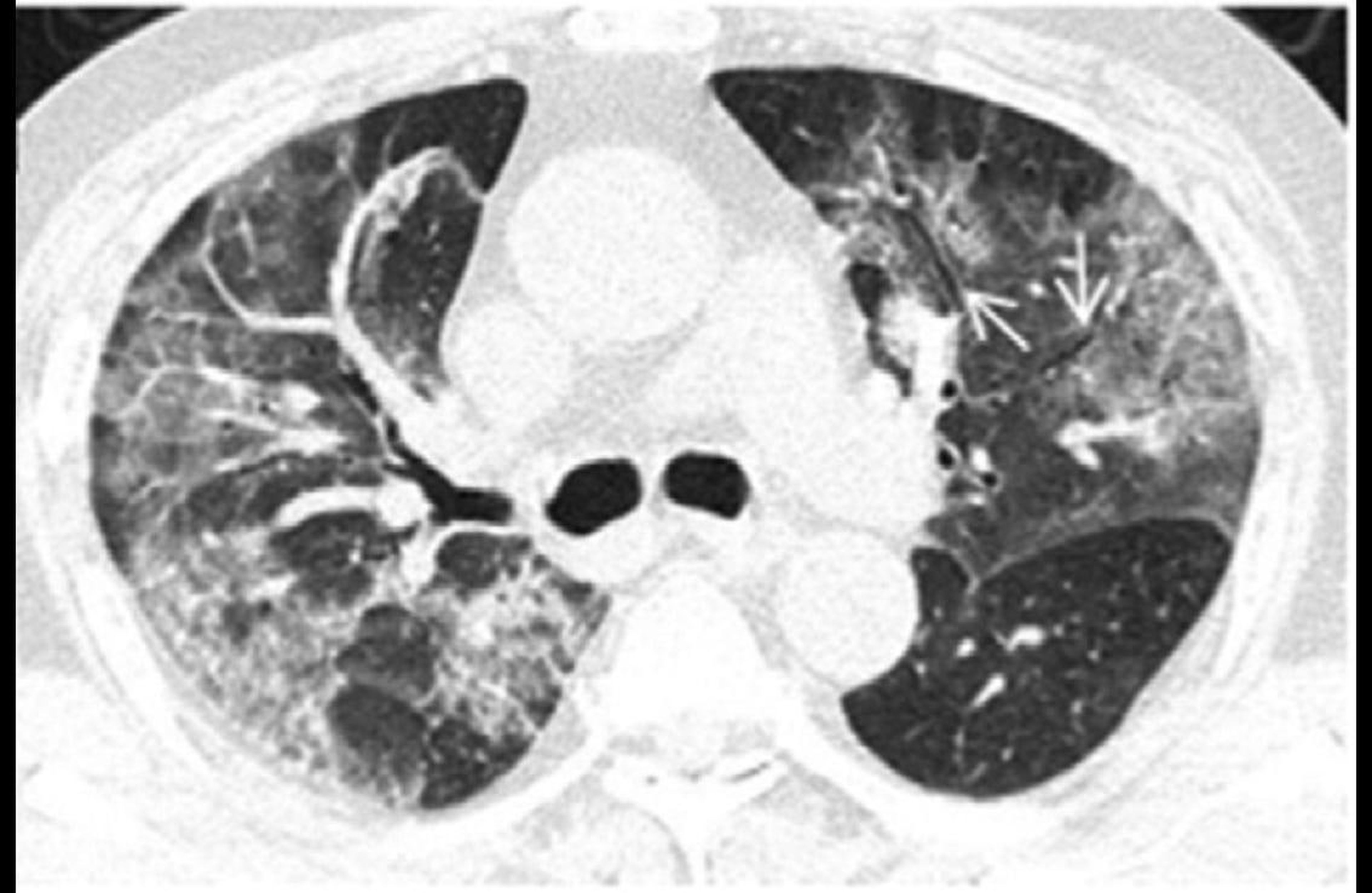 Una tomografía computarizada de los pulmones de un paciente con coronavirus.