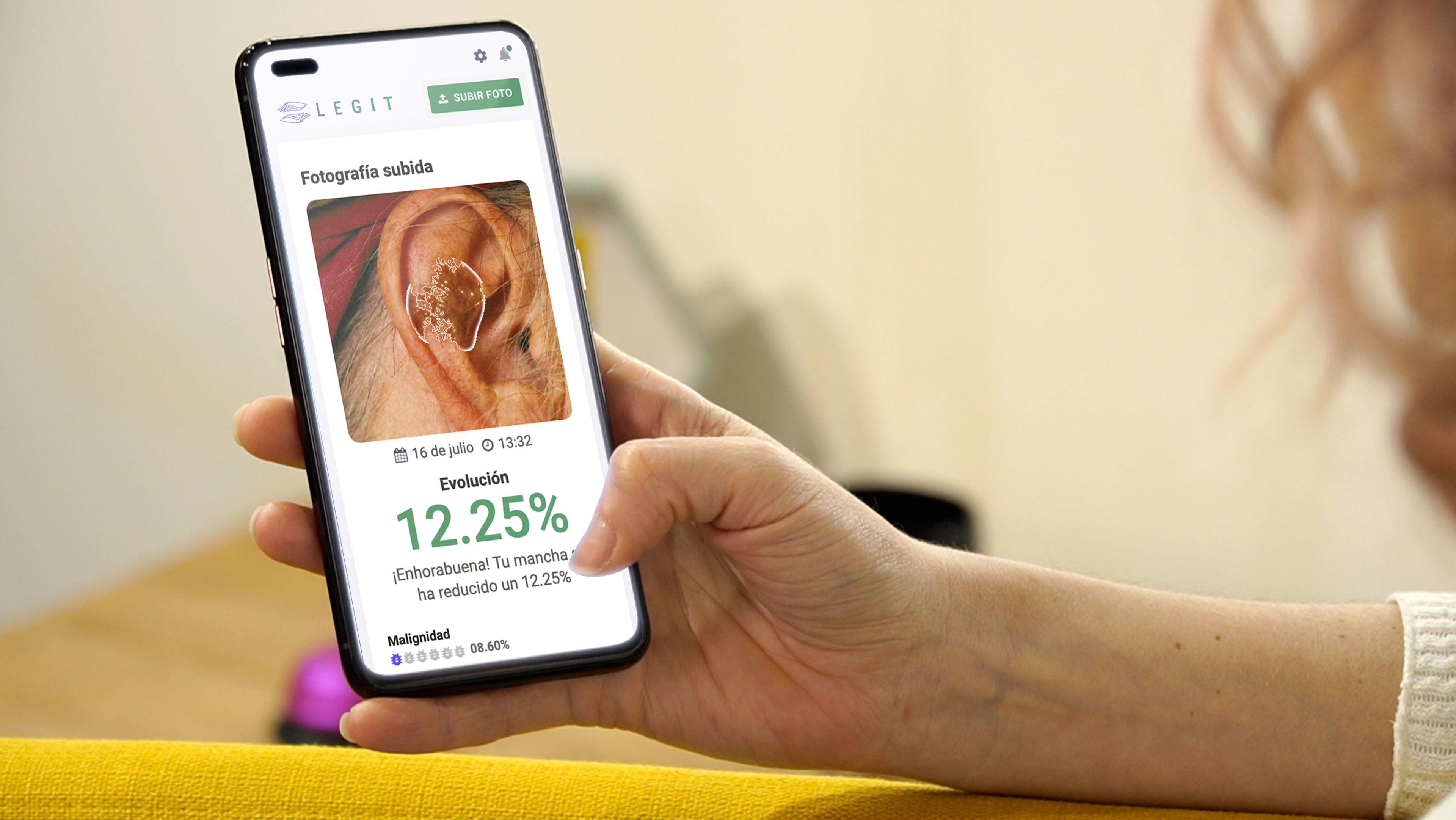 Detección de cáncer de piel con smartphone