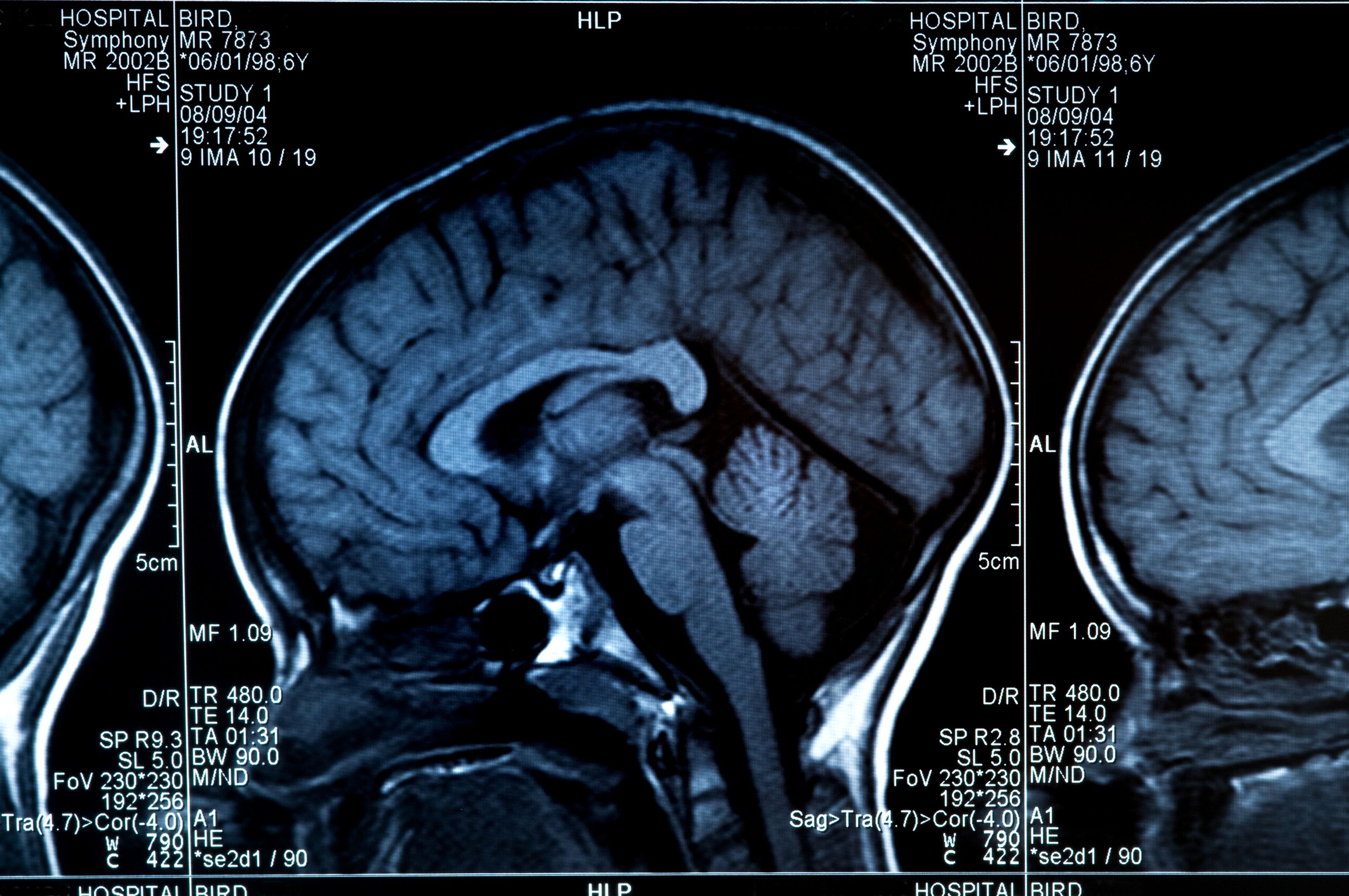 MRI del cerebro.