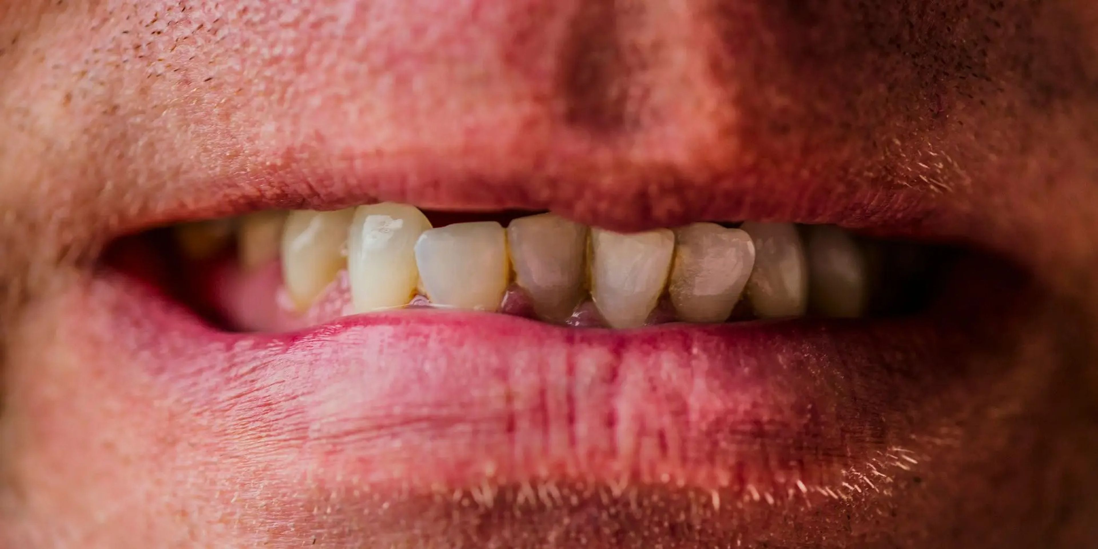 Tus dientes podrían deteriorase e incluso caerse si no tratas las caries.
