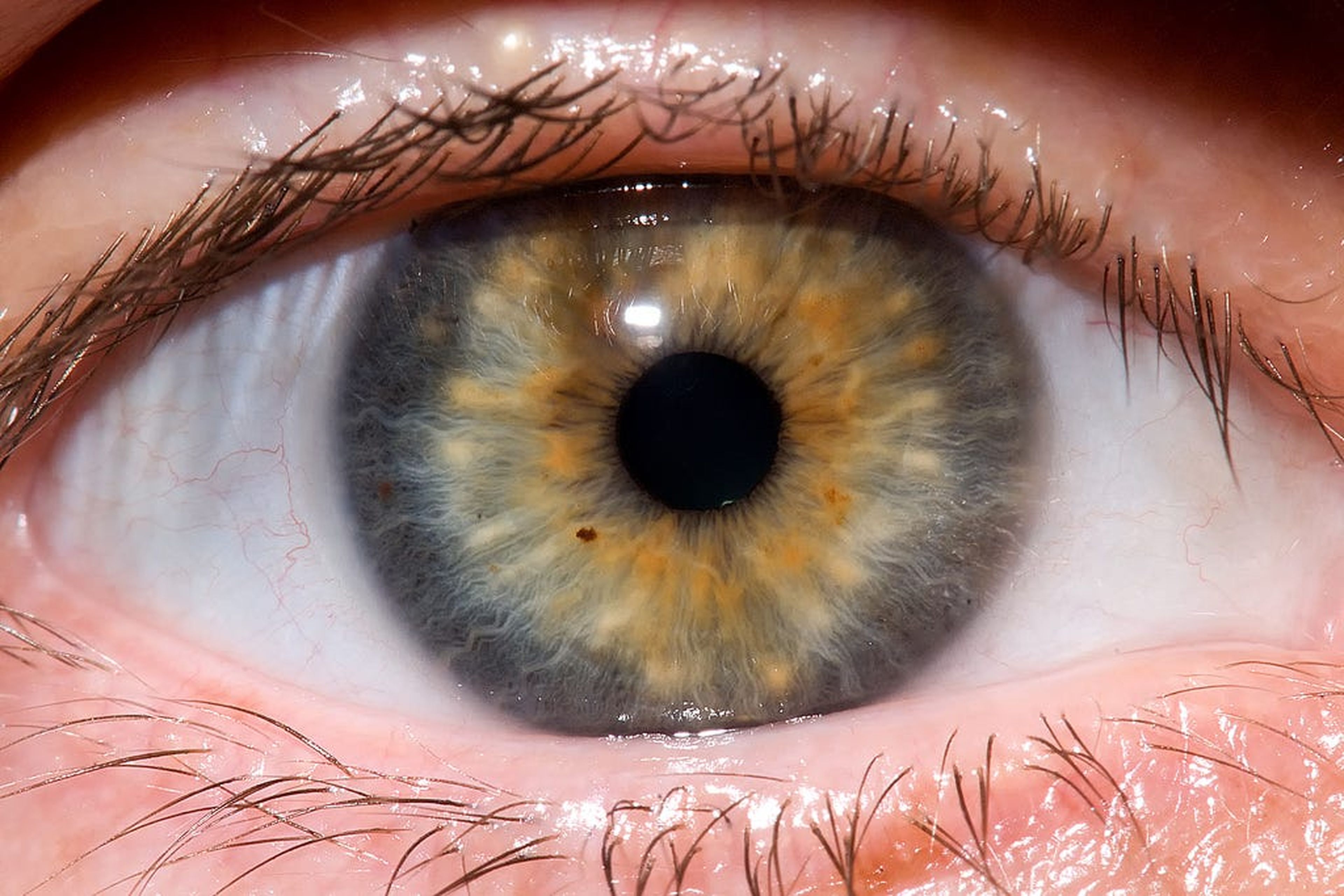 Los lazos pueden aumentar la presión ocular intraocular, que se considera un factor de riesgo de glaucoma y cataratas.