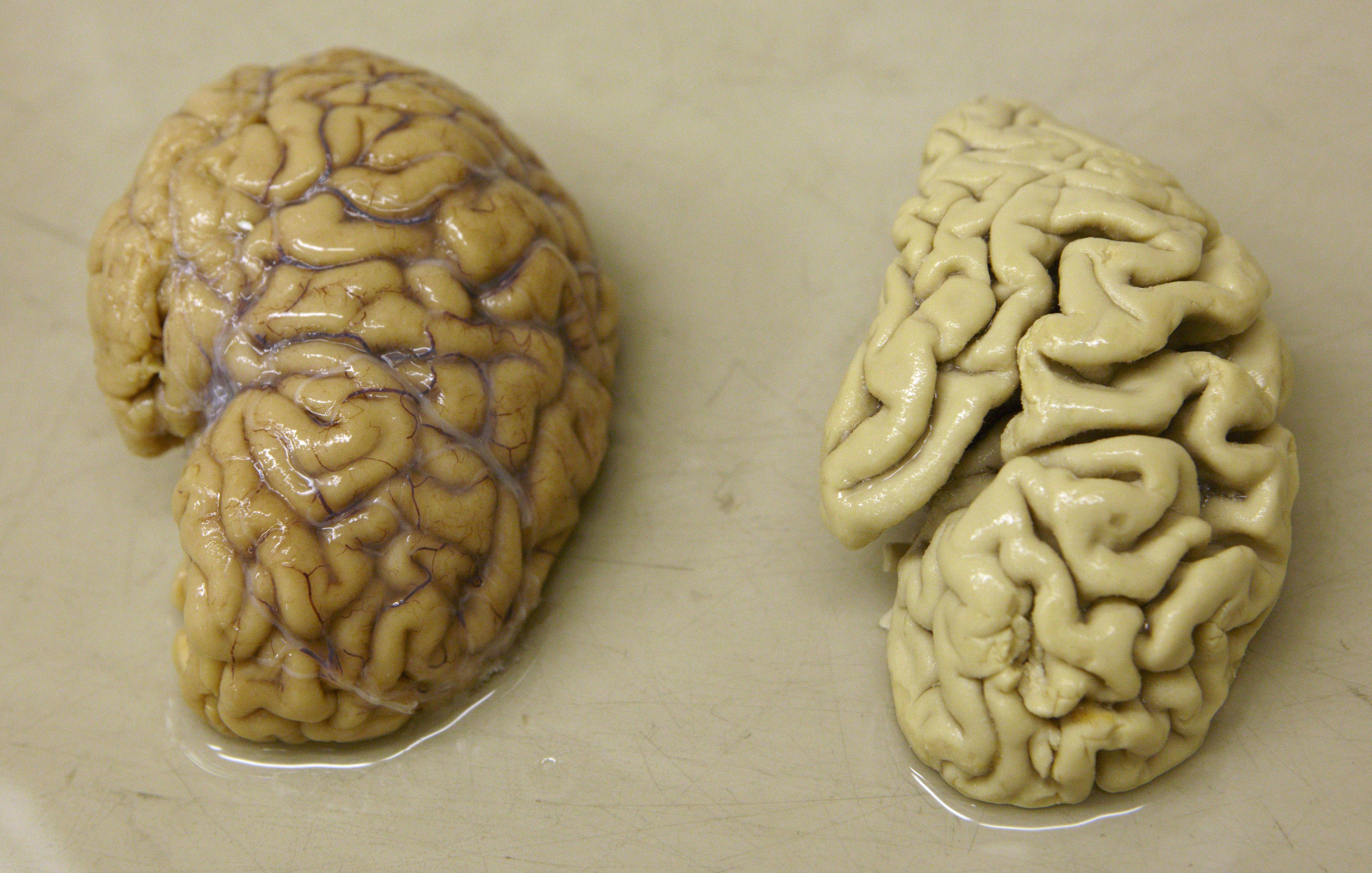 Un hemisferio de un cerebro sano (izquierda) junto a un hemisferio de un cerebro de una persona con la enfermedad de Alzheimer (derecha).