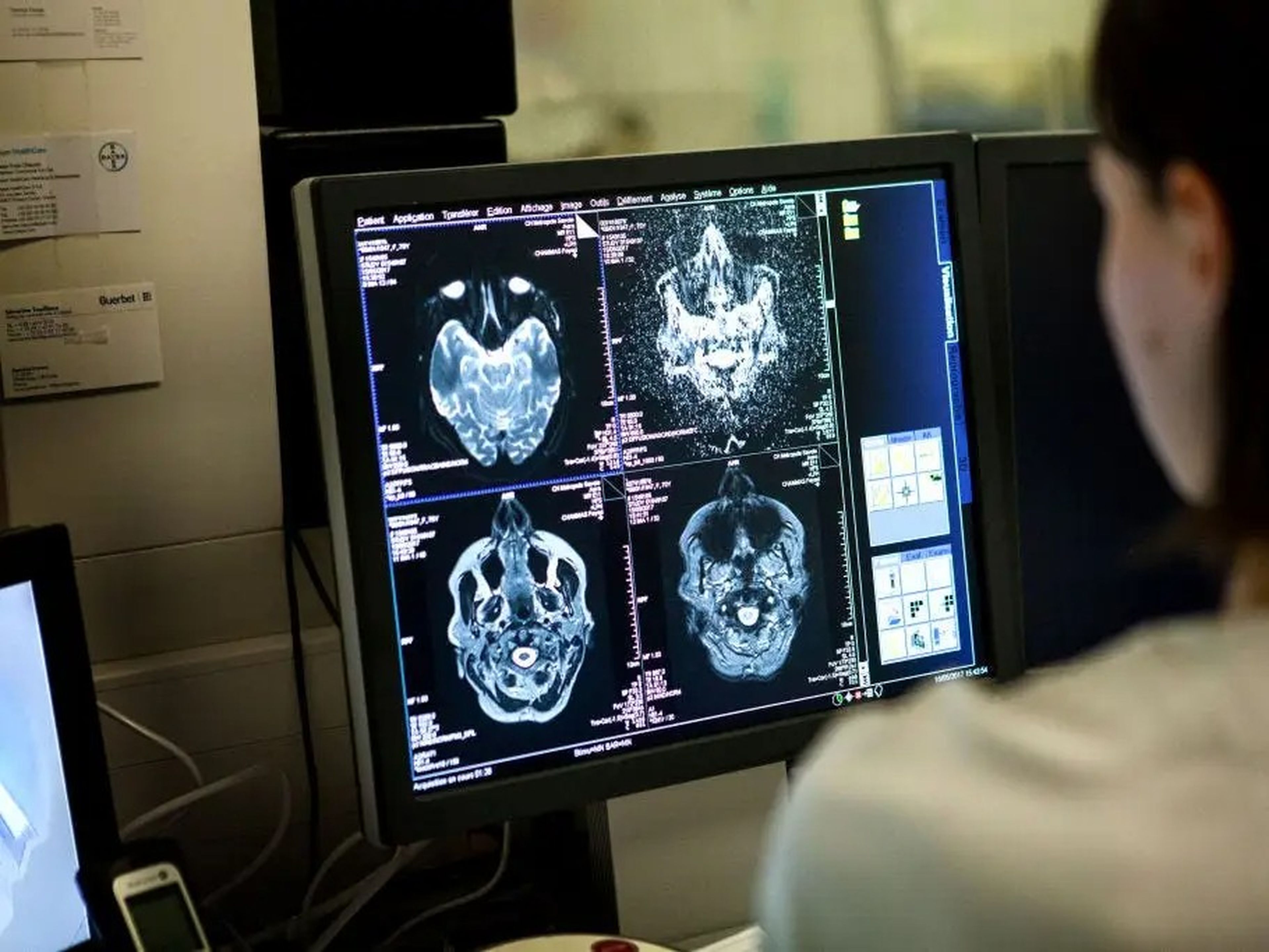 Imagen médica en un hospital de Saboya, Francia. Un técnico supervisa una sesión de resonancia magnética cerebral.