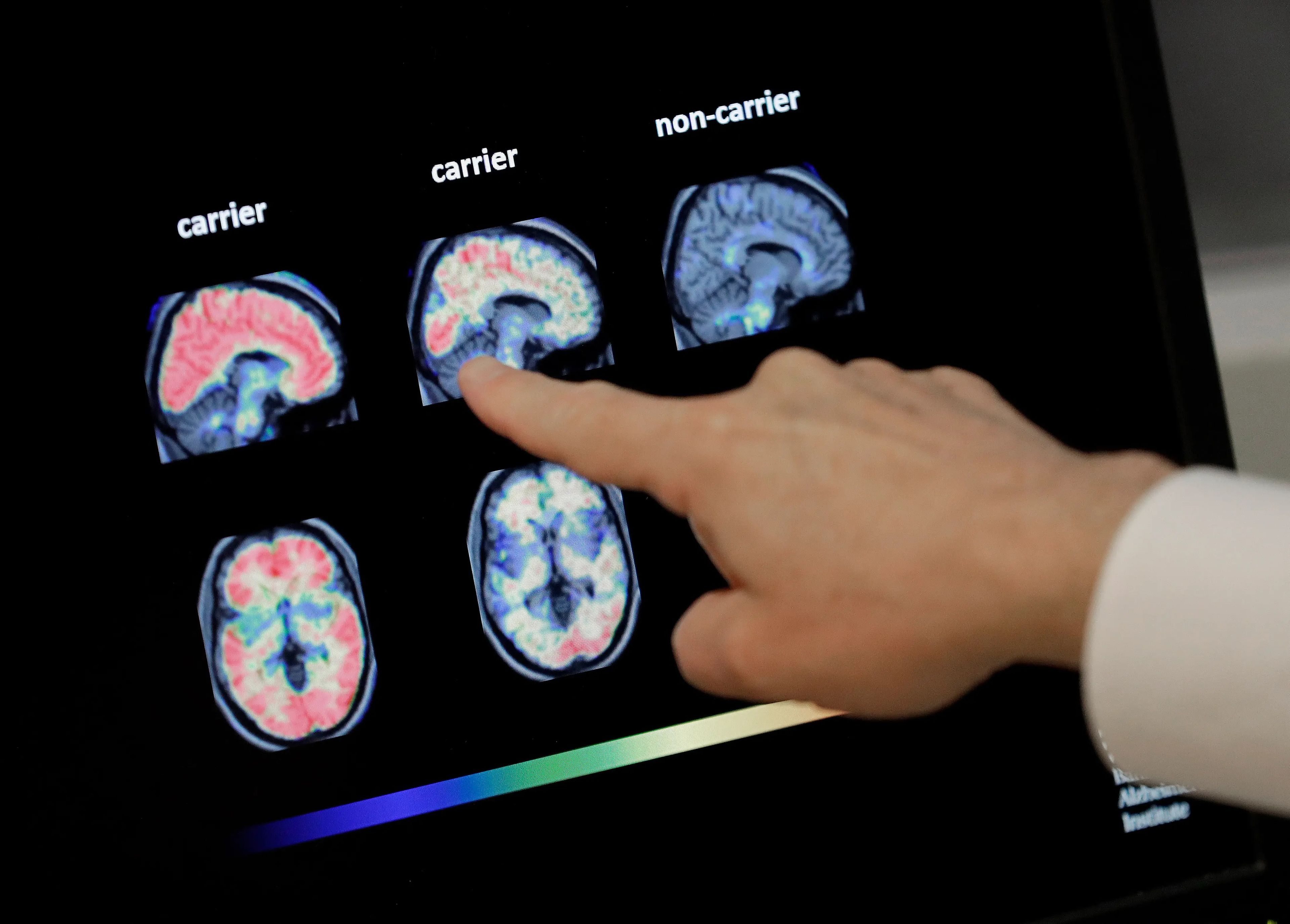 Un médico revisa un escáner cerebral PET en el Banner Alzheimer's Institute de Phoenix.