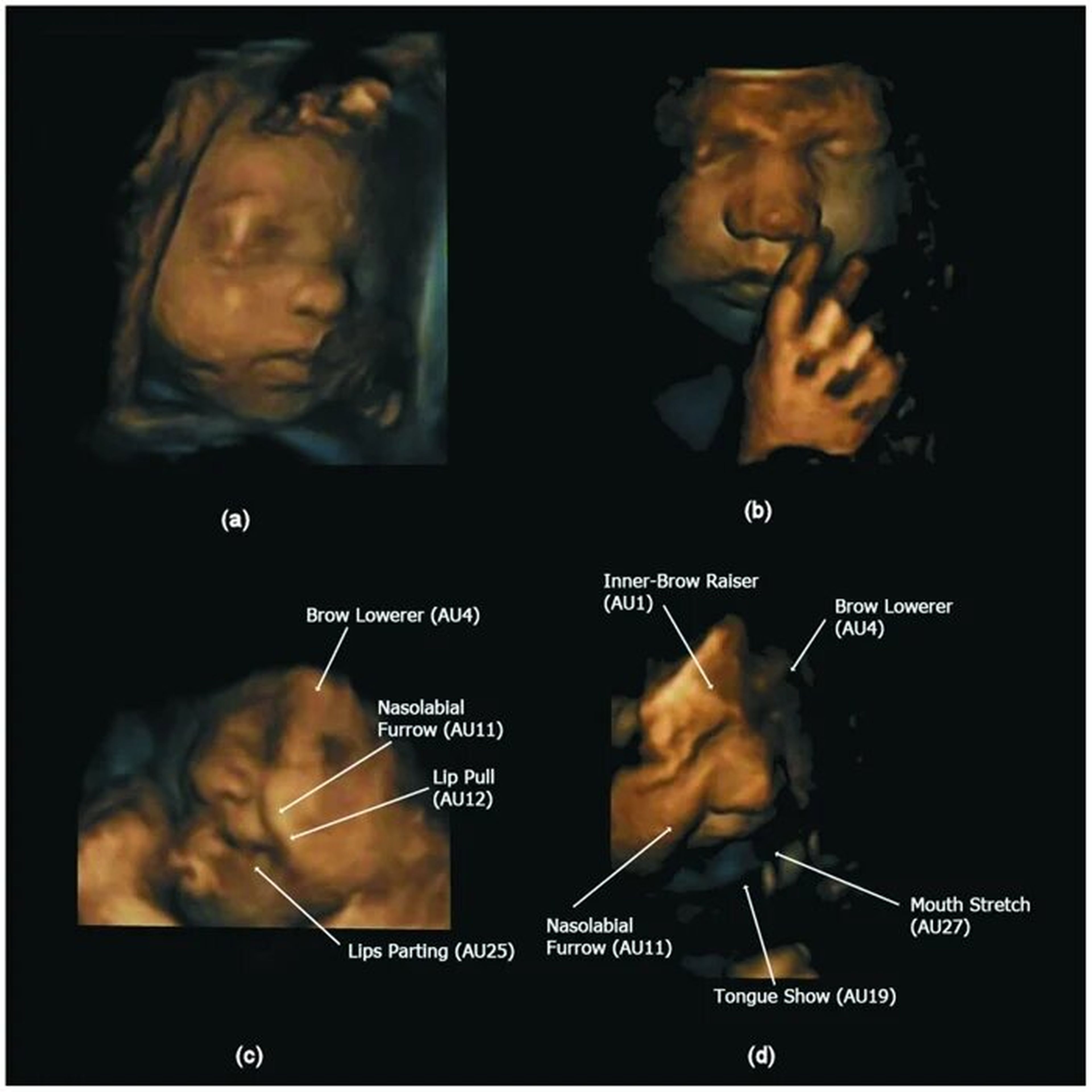Imágenes de ultrasonido de un feto, incluida la cara de llanto en la parte inferior derecha.