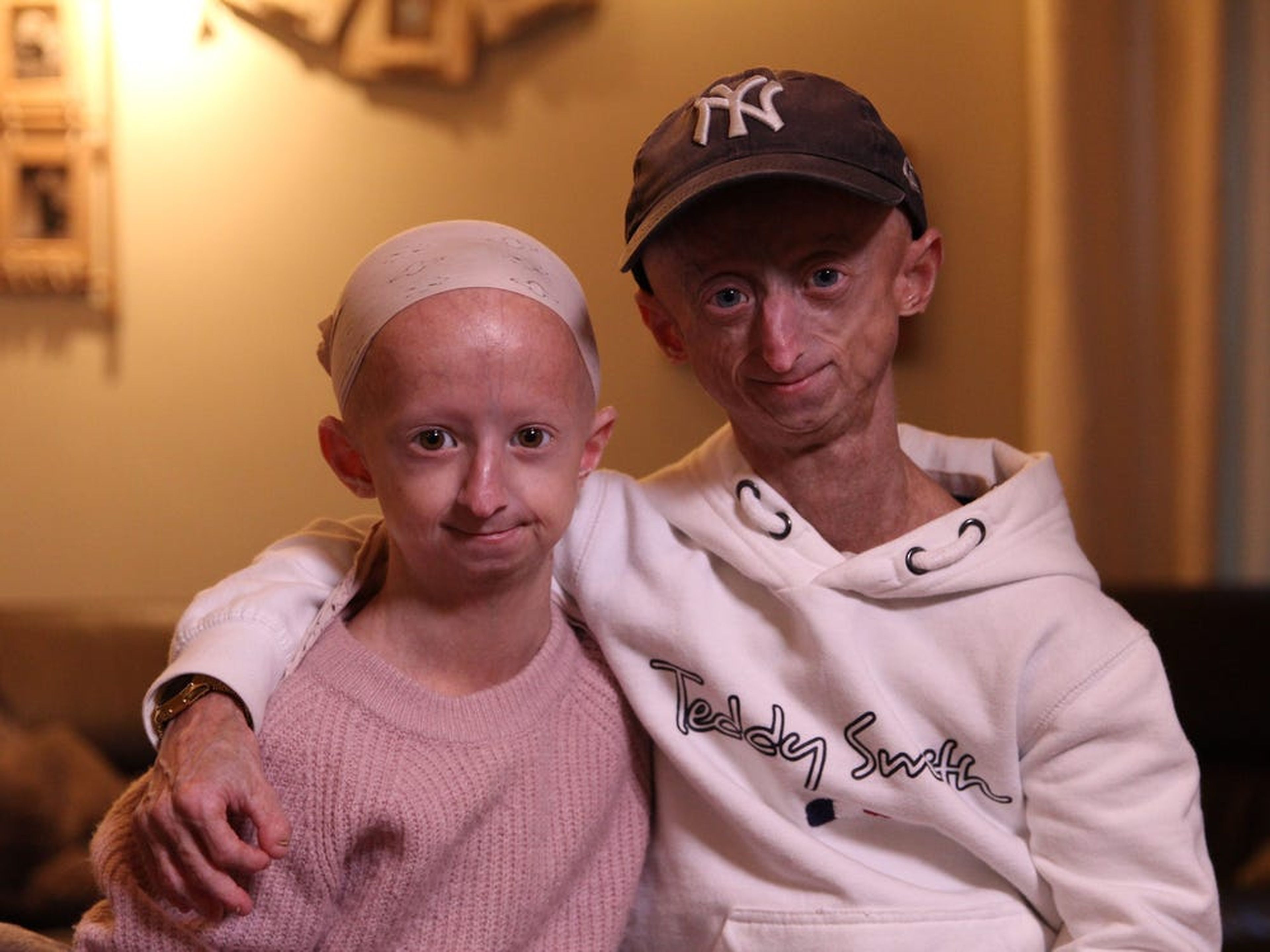 Los hermanos Michiel y Amber Vandeweert padecen progeria, una enfermedad genética caracterizada por los signos de un envejecimiento acelerado y prematuro.