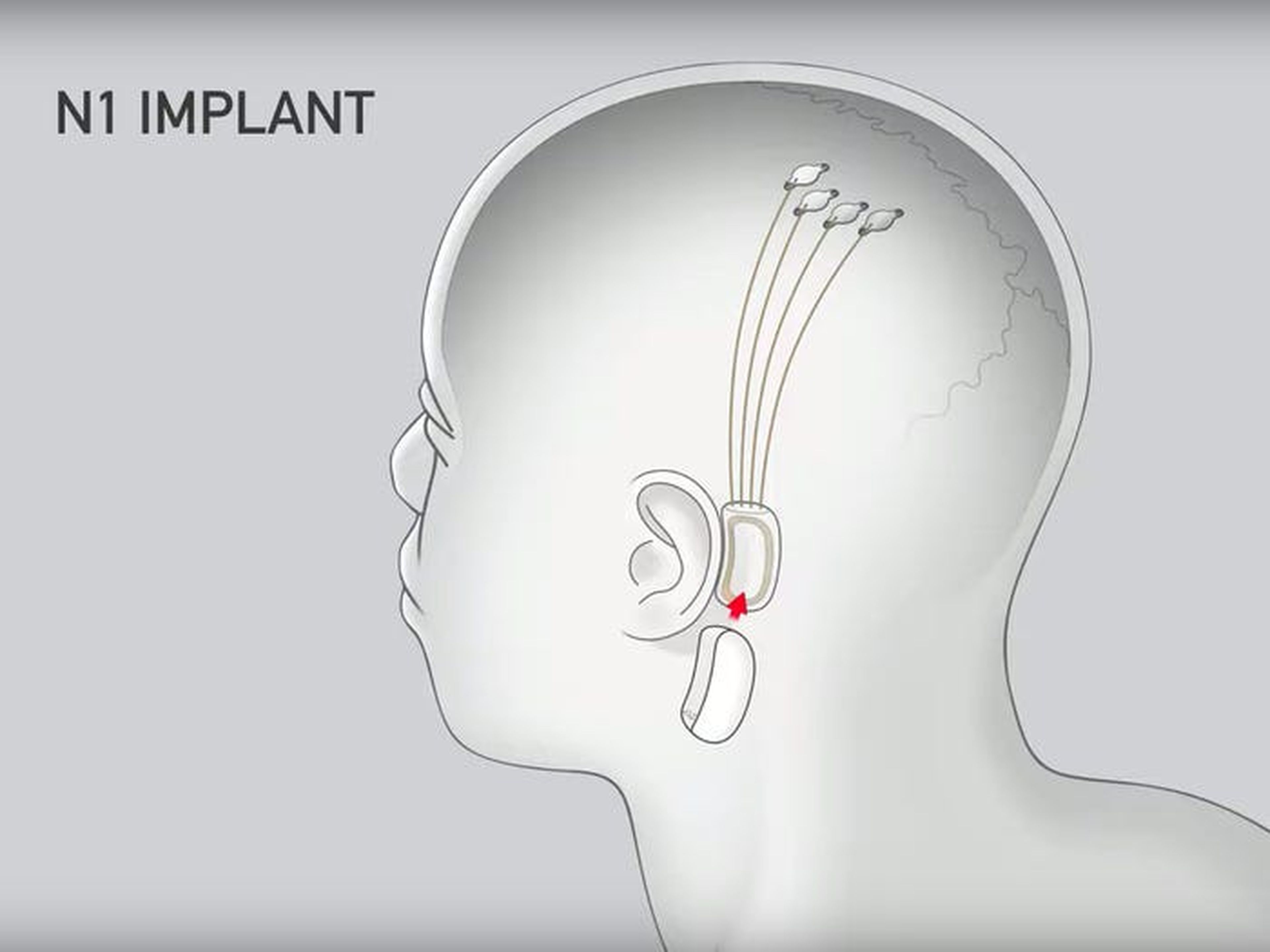 El chip se coloca detrás de la oreja, mientras que los electrodos se introducen en el cerebro.