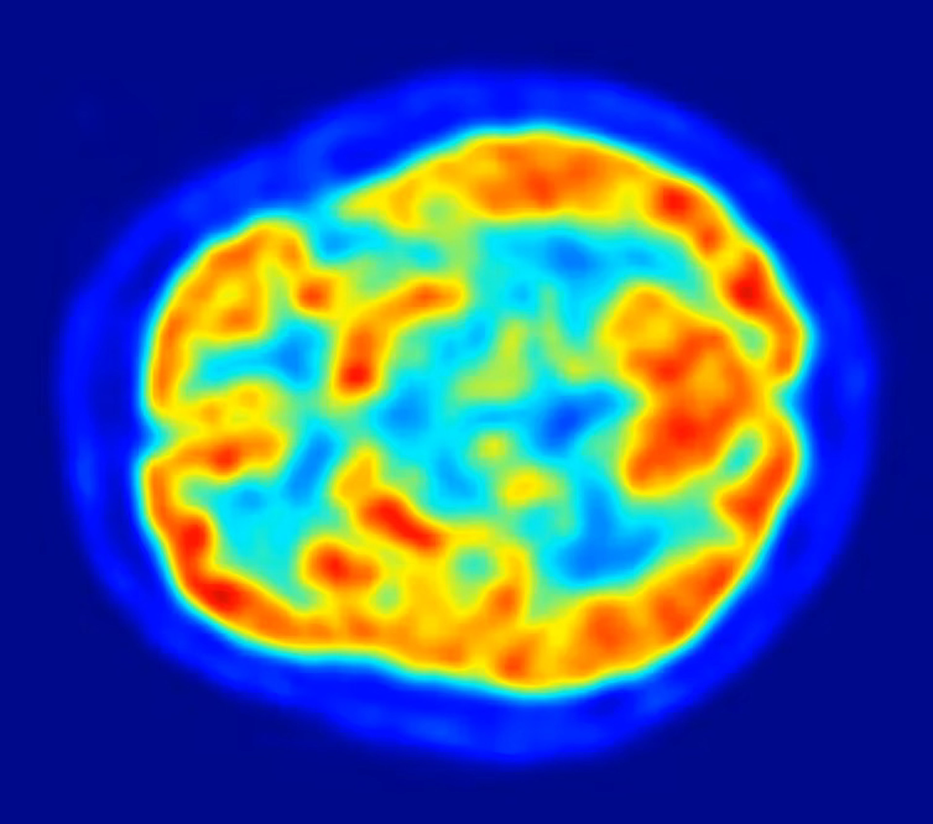 Una tomografía por emisión de positrones (PET) del cerebro humano puede revelar áreas con más actividad (en rojo).