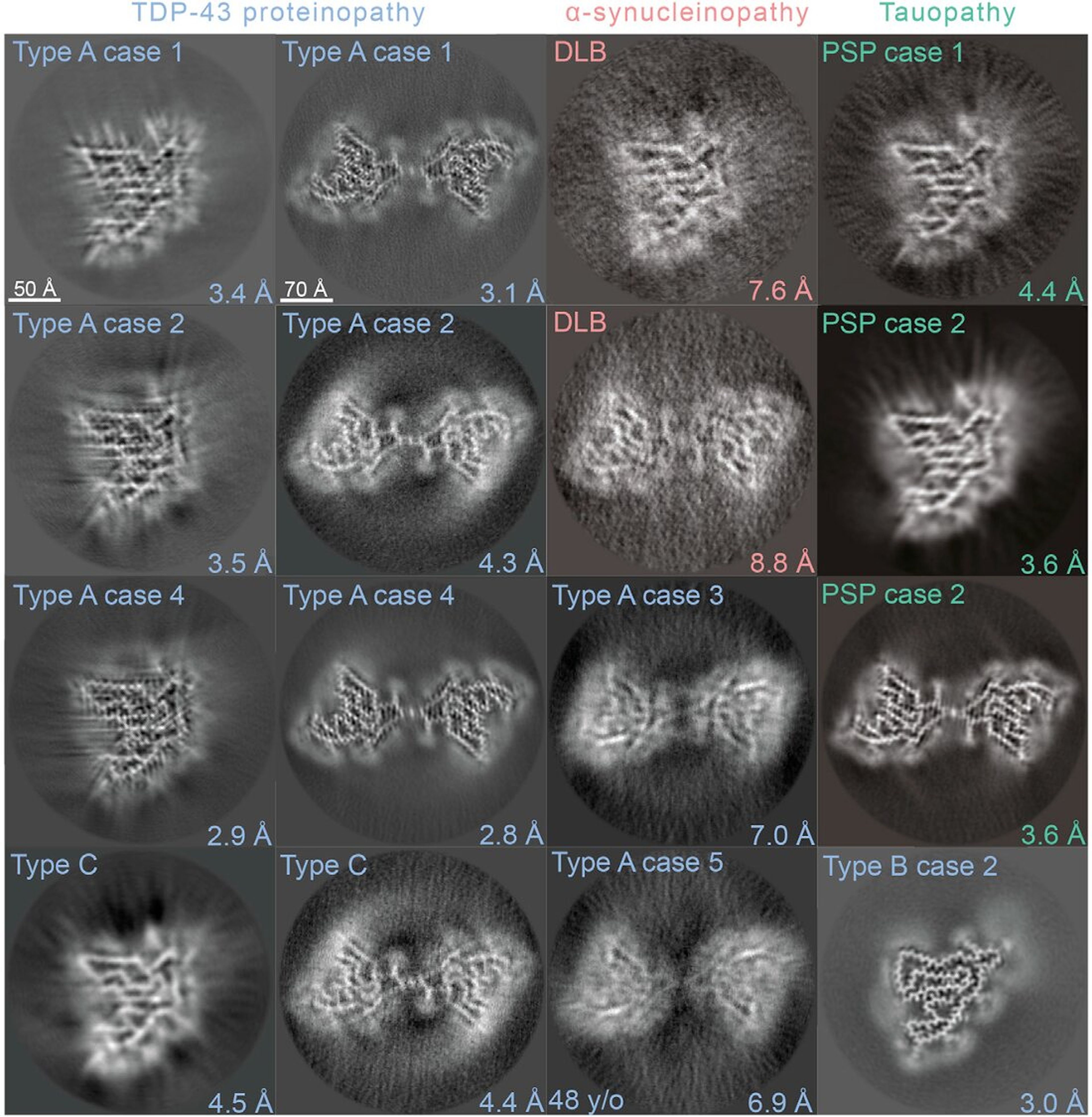 Imágenes crio-EM de fibrillas de proteínas encontradas en muestras de tejido cerebral.