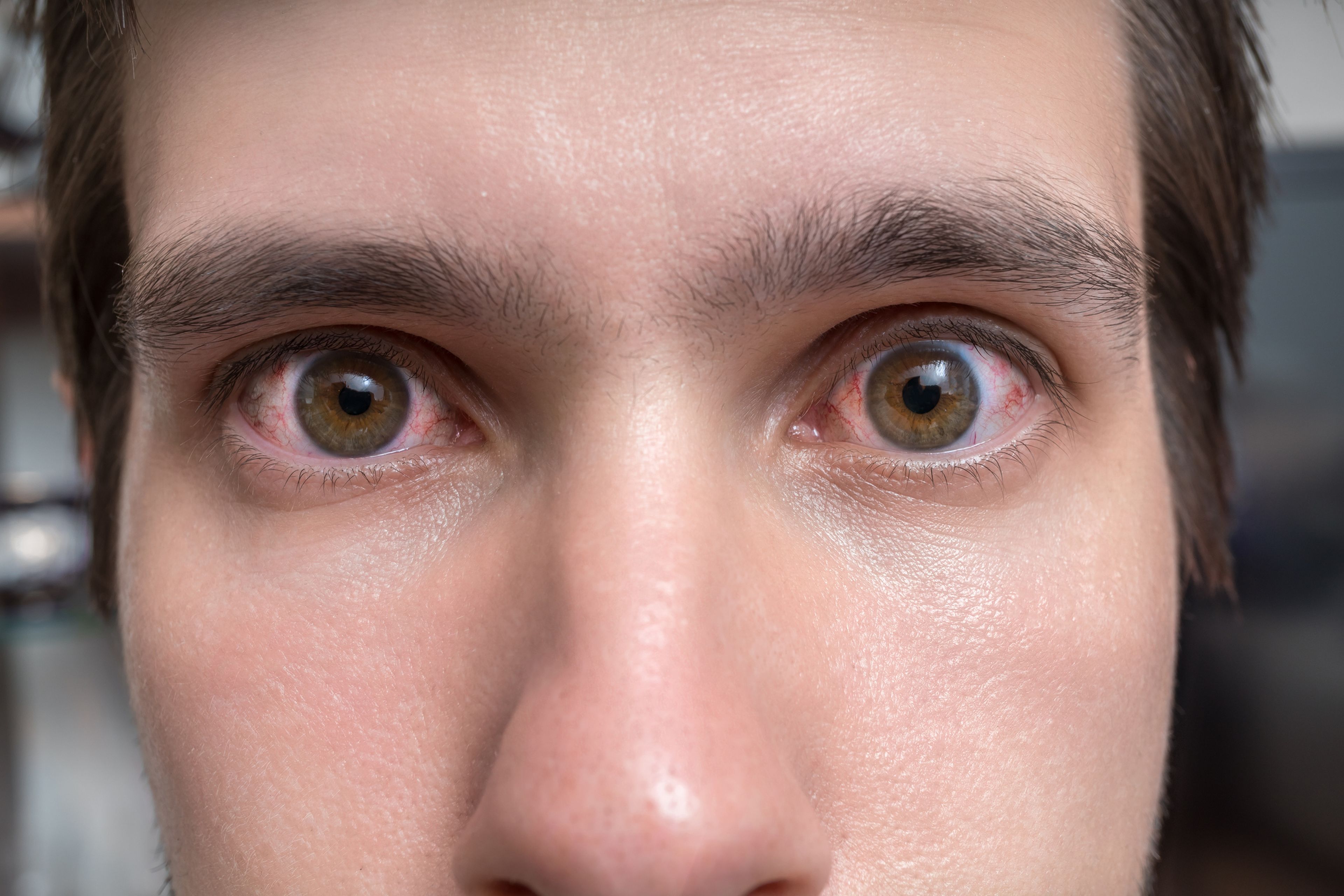 Как называется болезнь когда разный цвет глаз. Гетерохромия радужной оболочки. Центральная гетерохромия глаз. Гетерохромия и анизокория. Разные глаза.