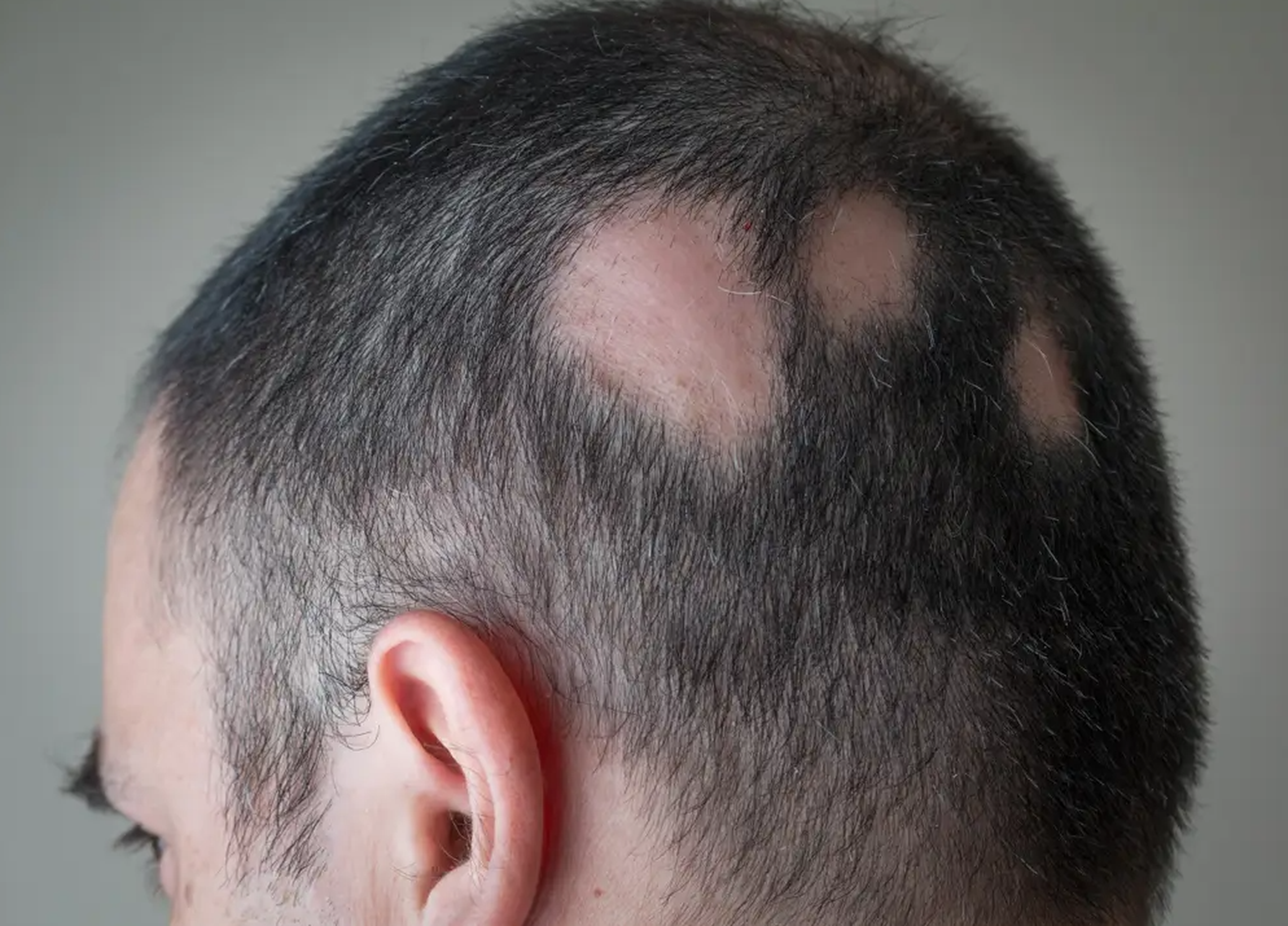 La alopecia areata puede producir que el cabello se caiga por completo o en parches.