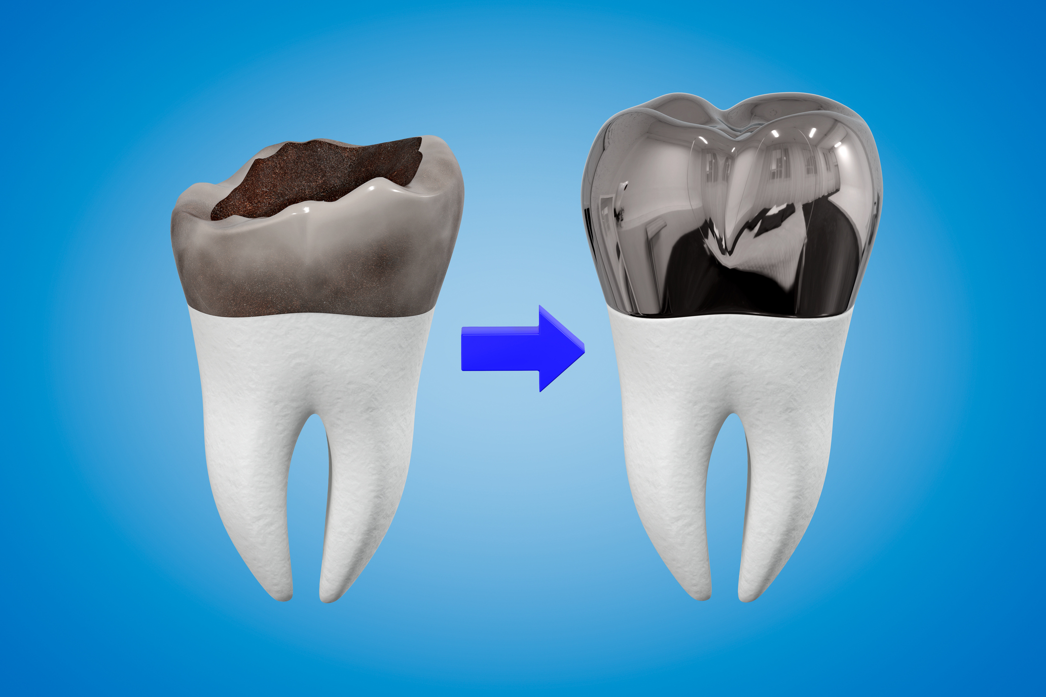 ¿Por qué elegir las coronas dentales?