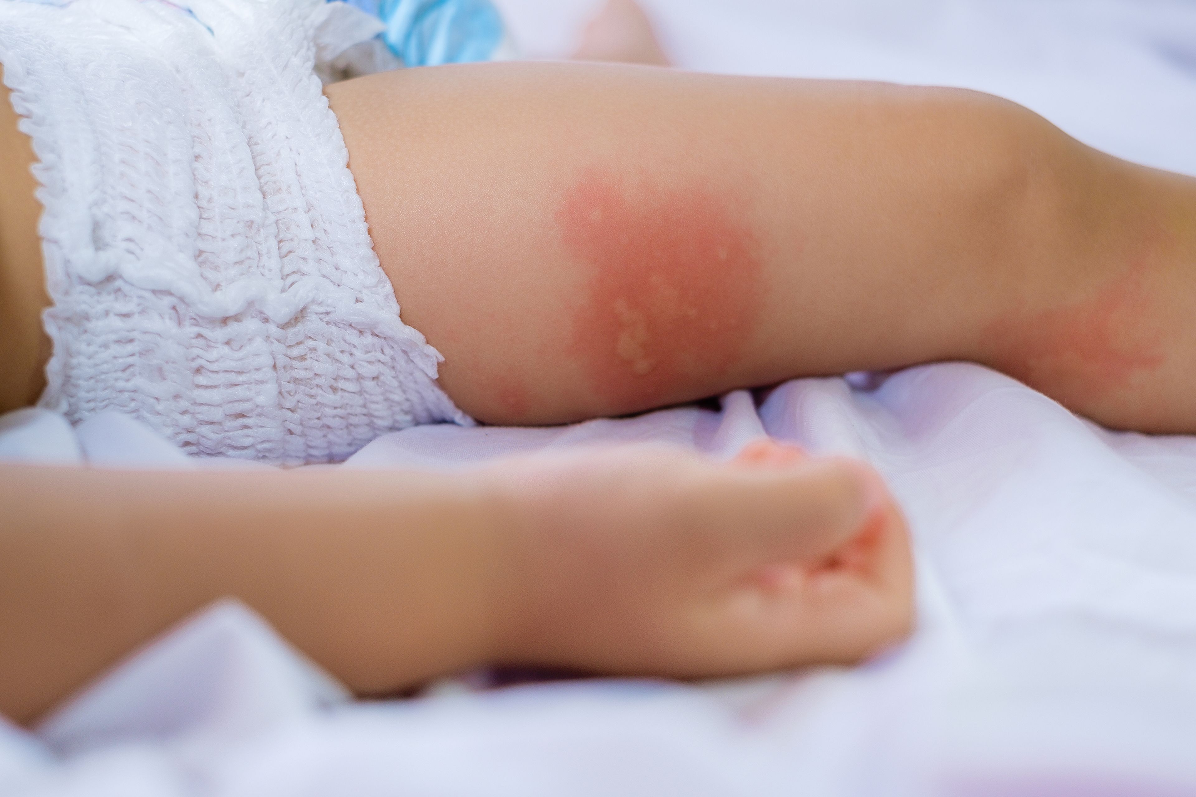 Algunas personas, sobre todo los niños, pueden mostrar sensibilidad a la picadura de mosquito.