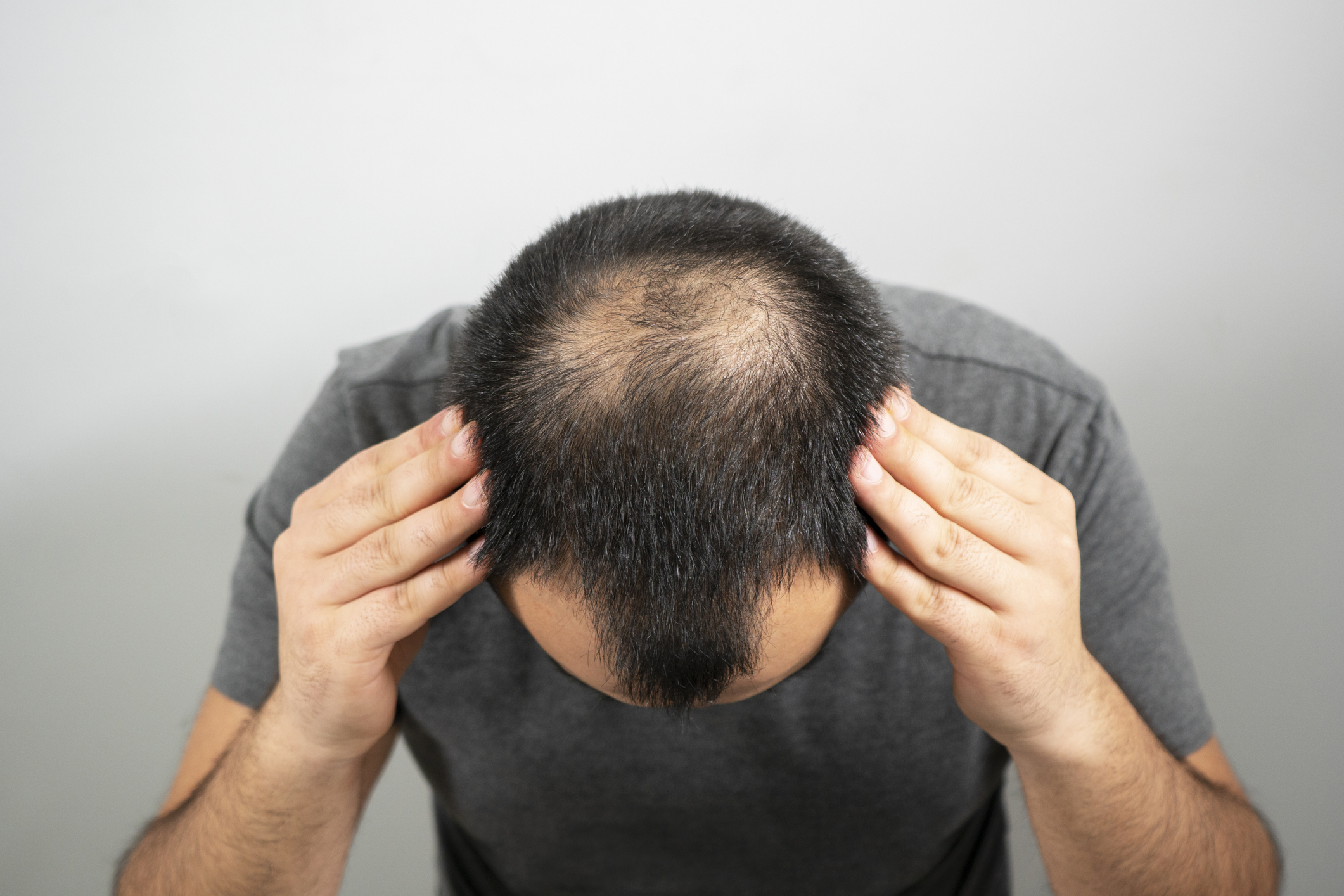 Minoxidil: la pastilla barata y contra la alopecia que no puedes comprar | Business Insider España