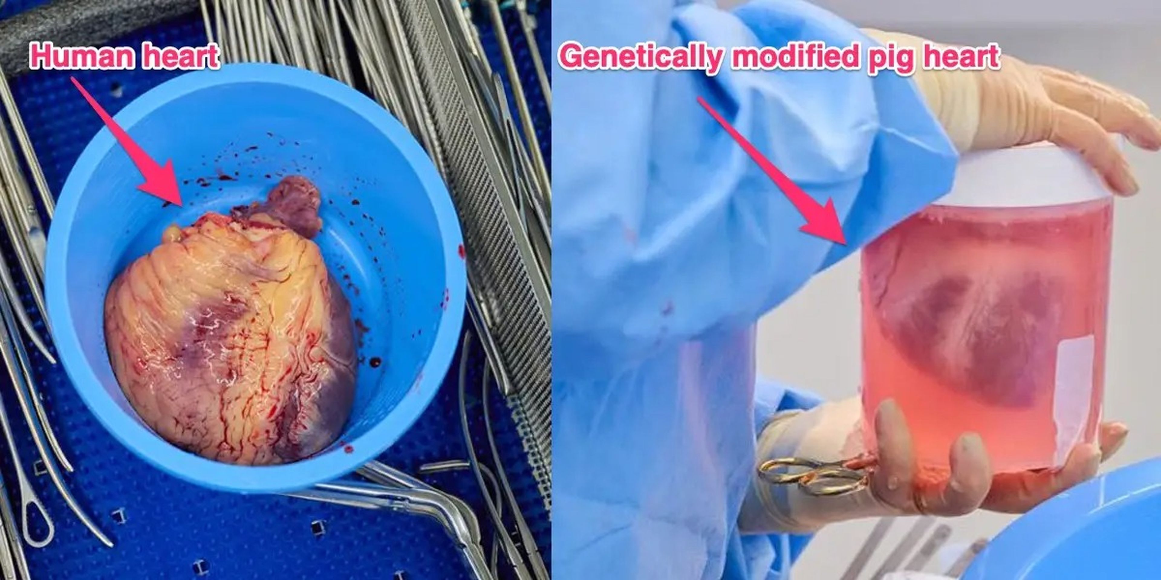Un corazón humano después de la extracción, a la izquierda. Un corazón de cerdo modificado genéticamente para trasplante humano, a la derecha.
