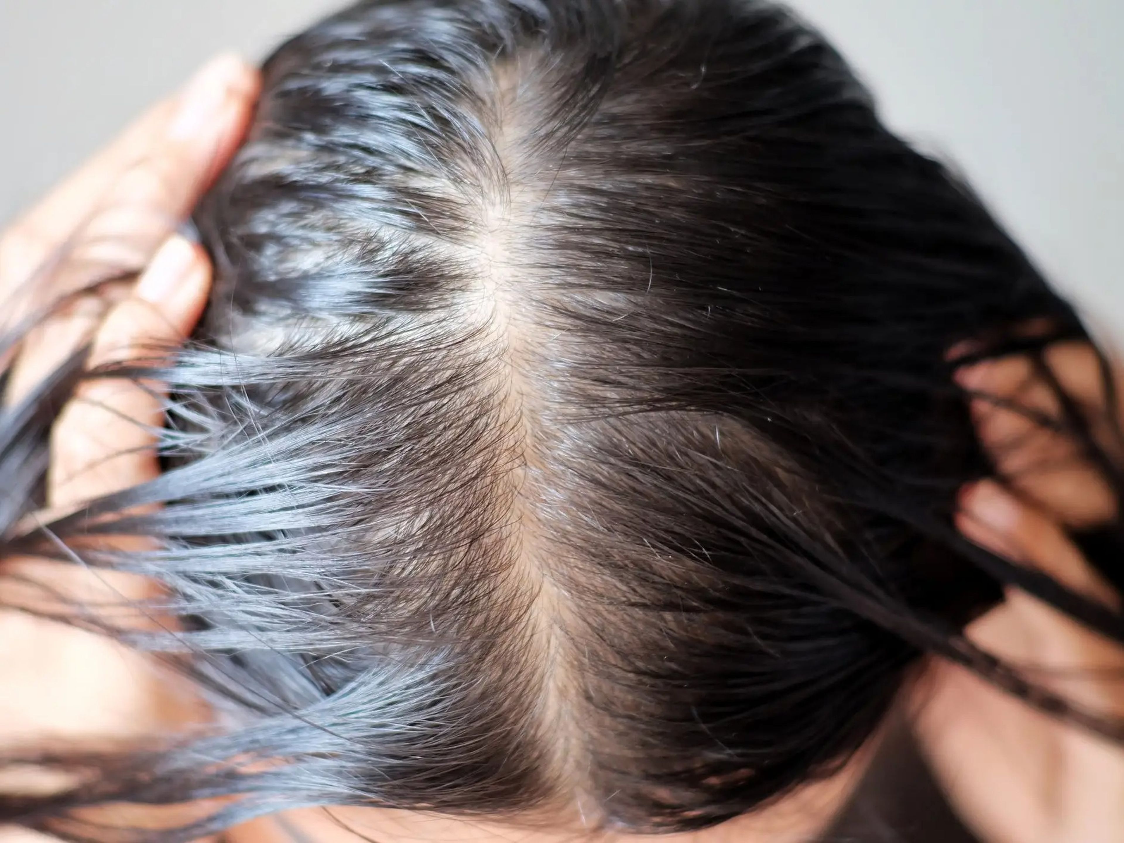 Un fármaco de varias décadas utilizado de un nuevo modo puede ayudar a tratar a mujeres y hombres jóvenes con adelgazamiento del cabello.
