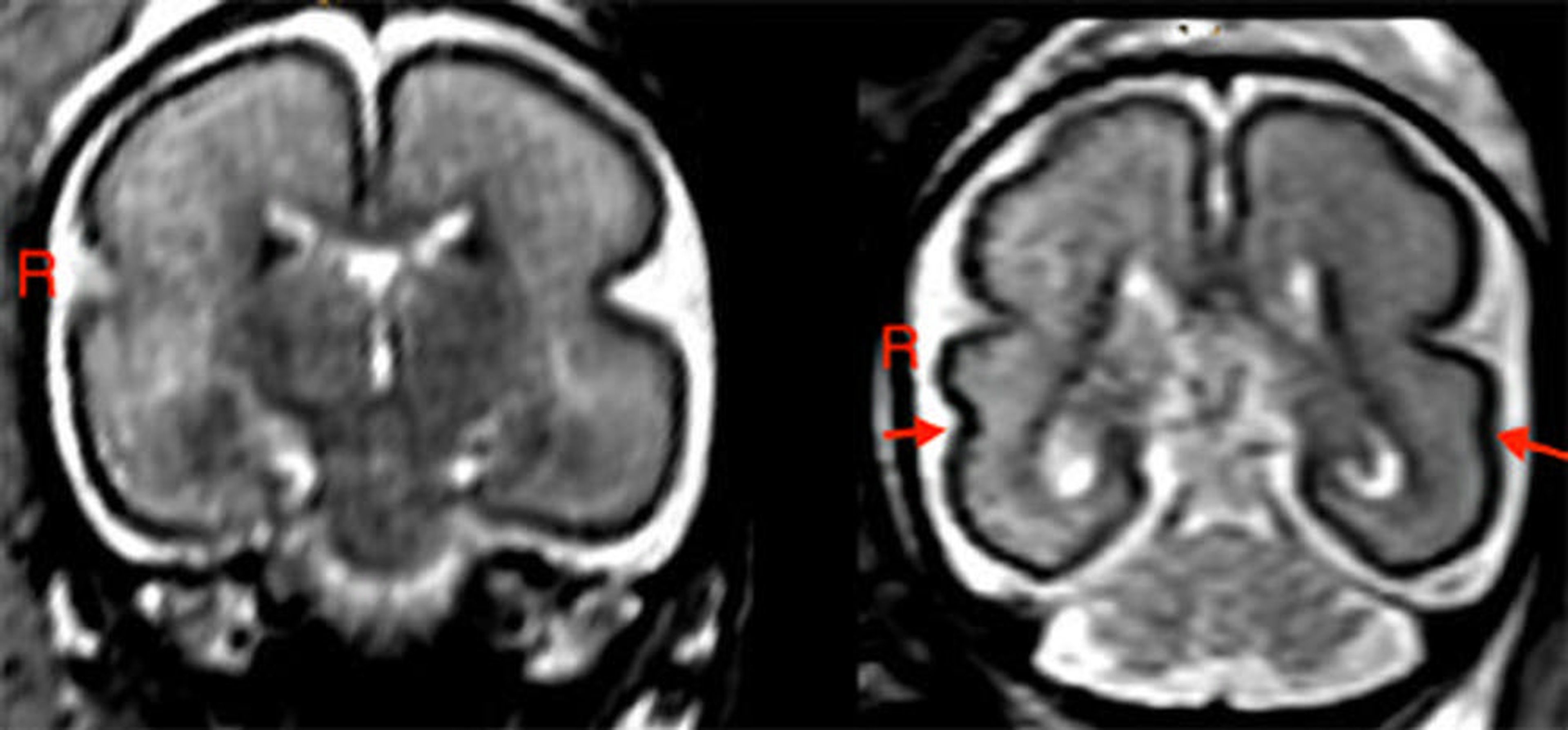 Un cerebro fetal expuesto al alcohol (izquierda) tiene una corteza más lisa en los lóbulos frontoparietal y temporal. En el control sano (derecha), el surco temporal superior (señalado por flechas) son más definidos.
