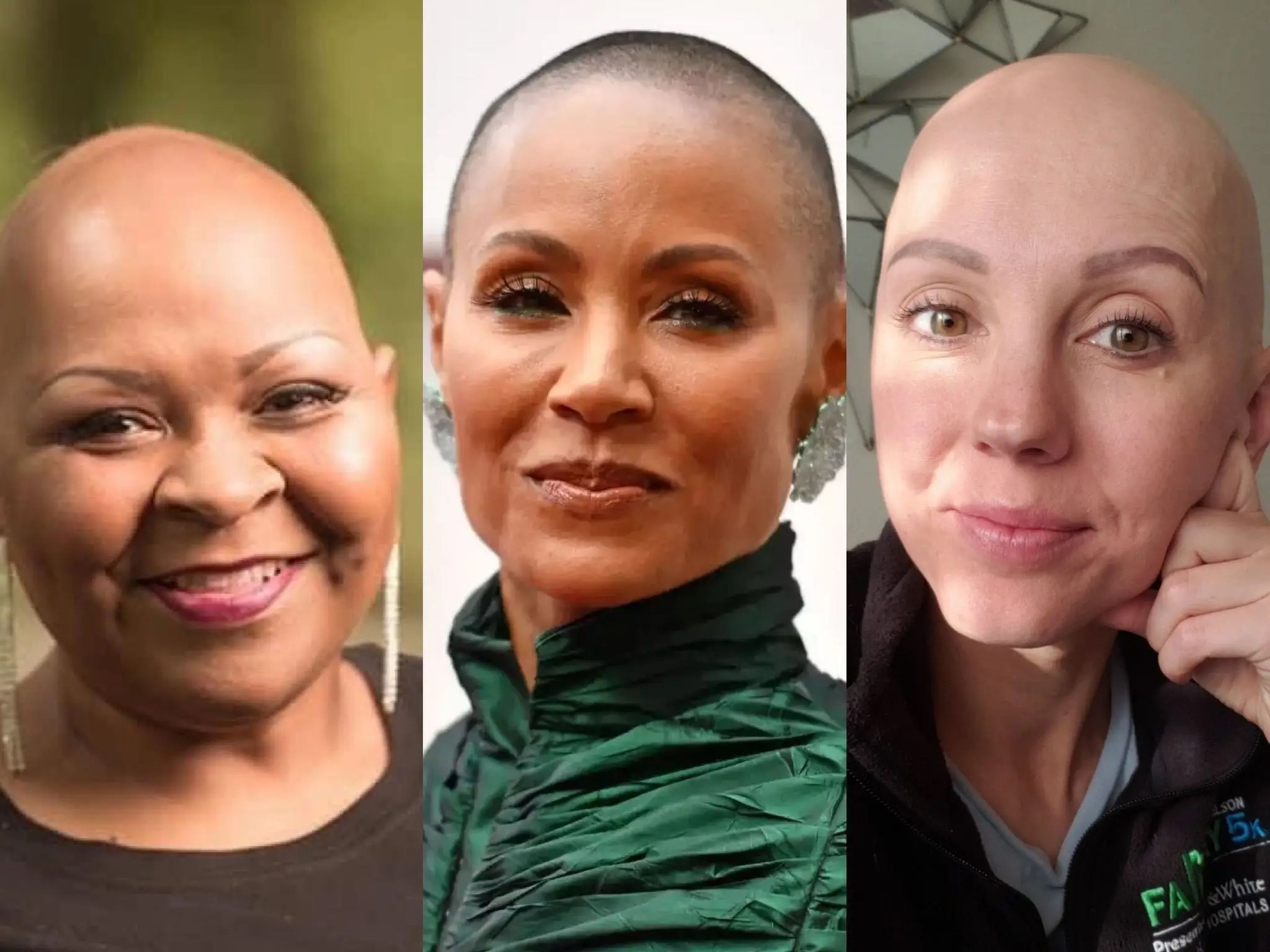 Jada y otras mujeres con alopecia