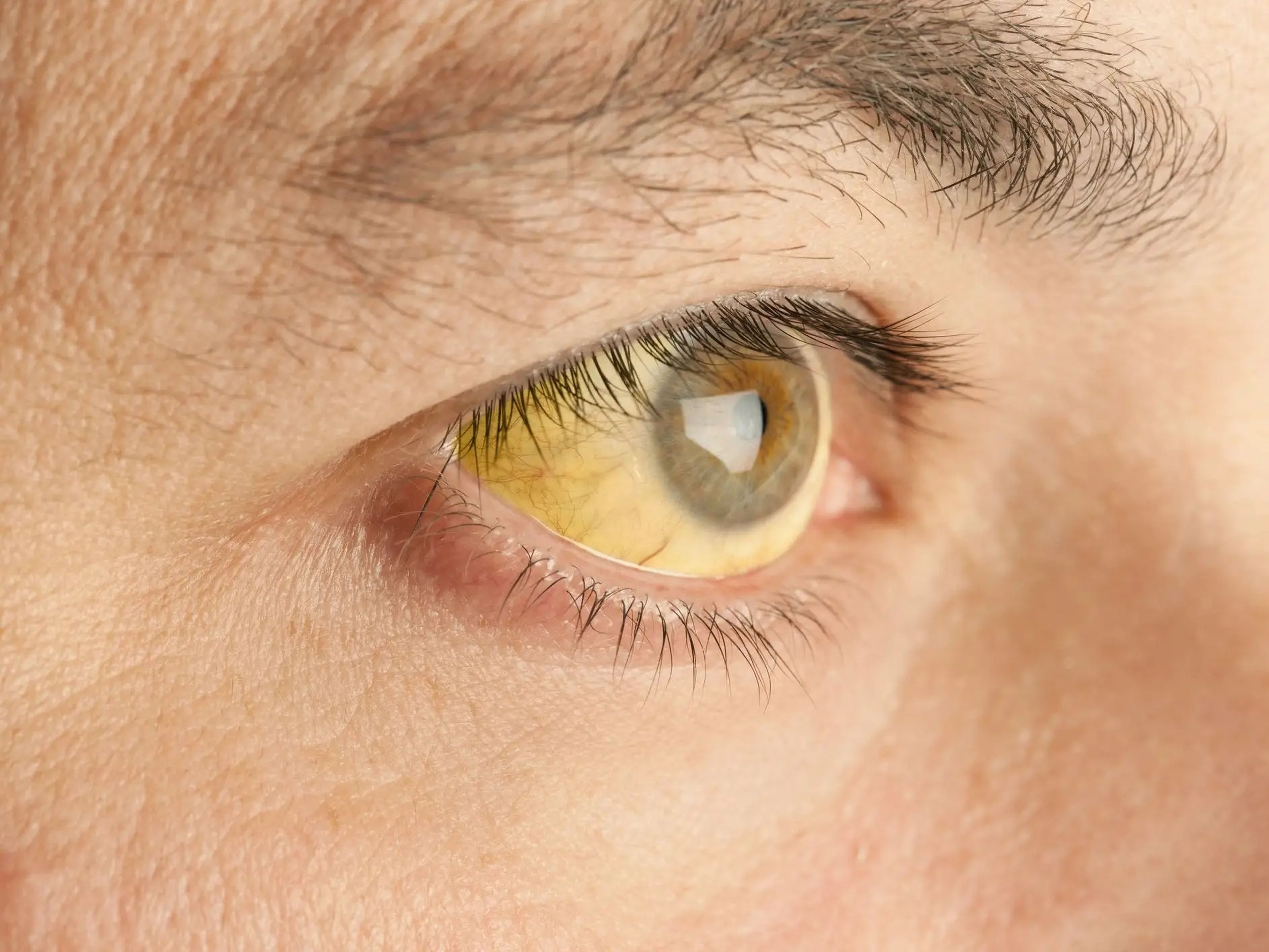 El color amarillento de los ojos puede ser un signo de cáncer de estómago avanzado, según el Instituto Nacional del Cáncer.