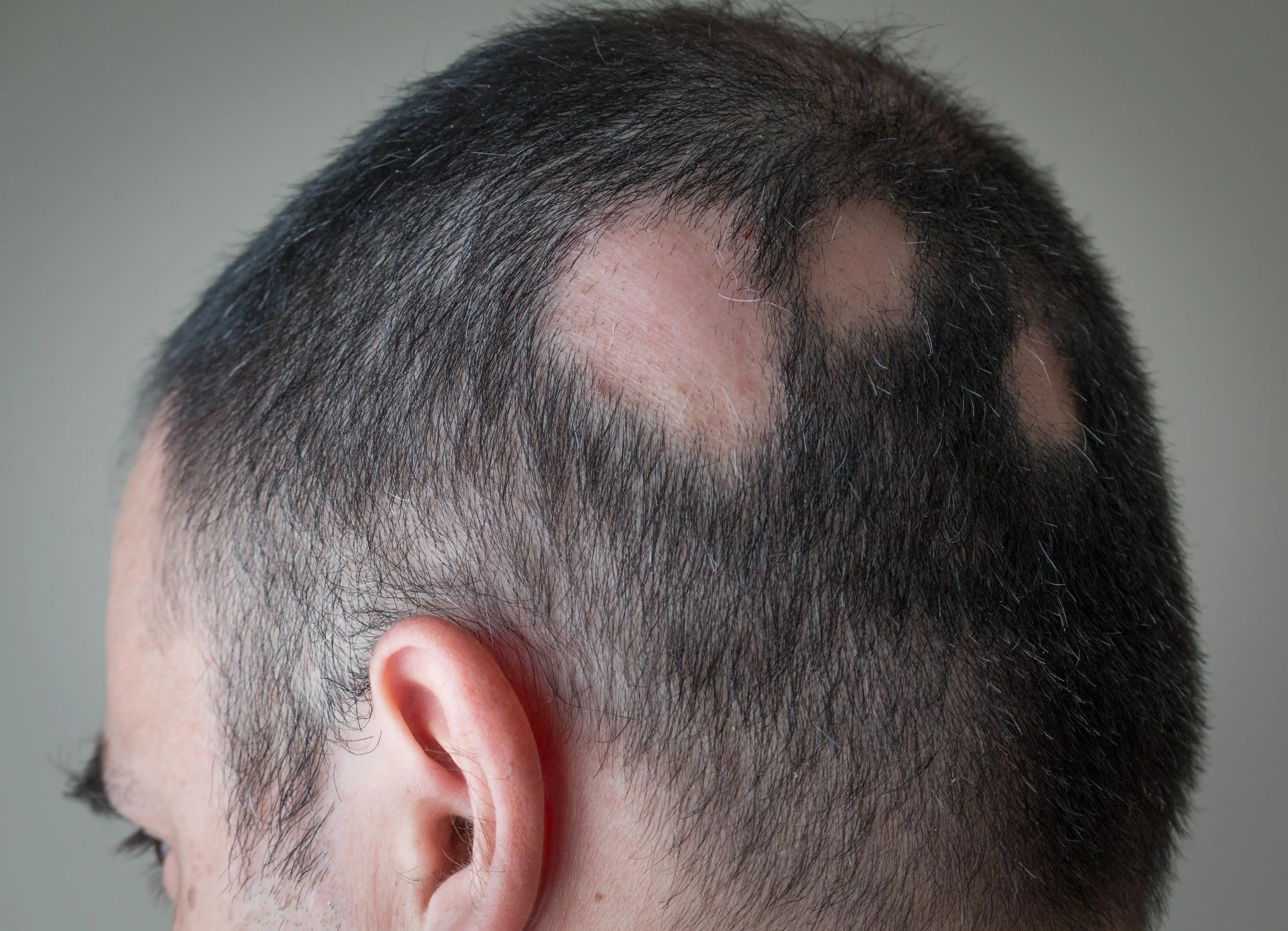 Hombre con alopecia areata