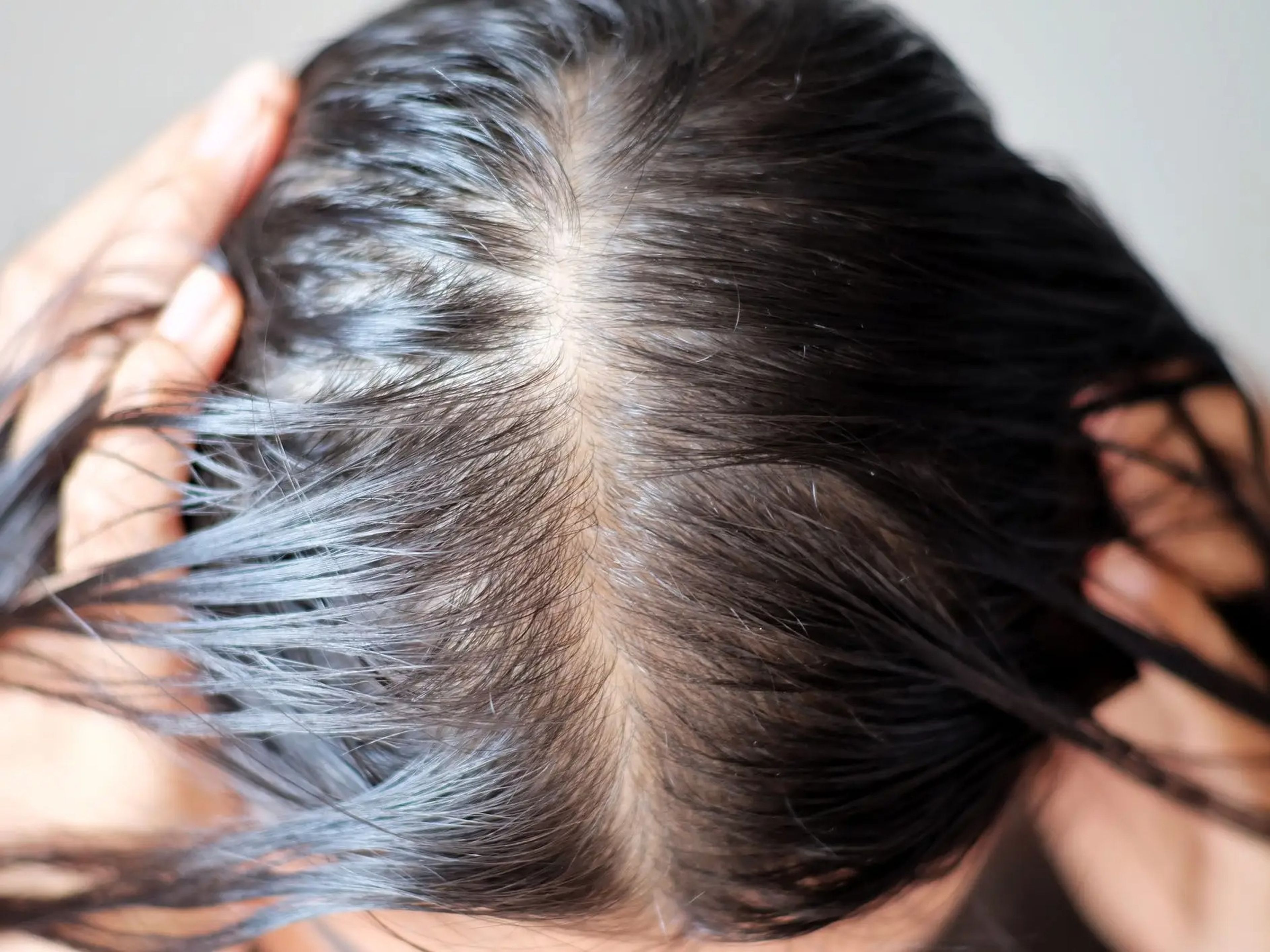 A diferencia de la pérdida de cabello de patrón masculino, la pérdida de cabello de patrón femenino suele presentarse como una parte ensanchada.