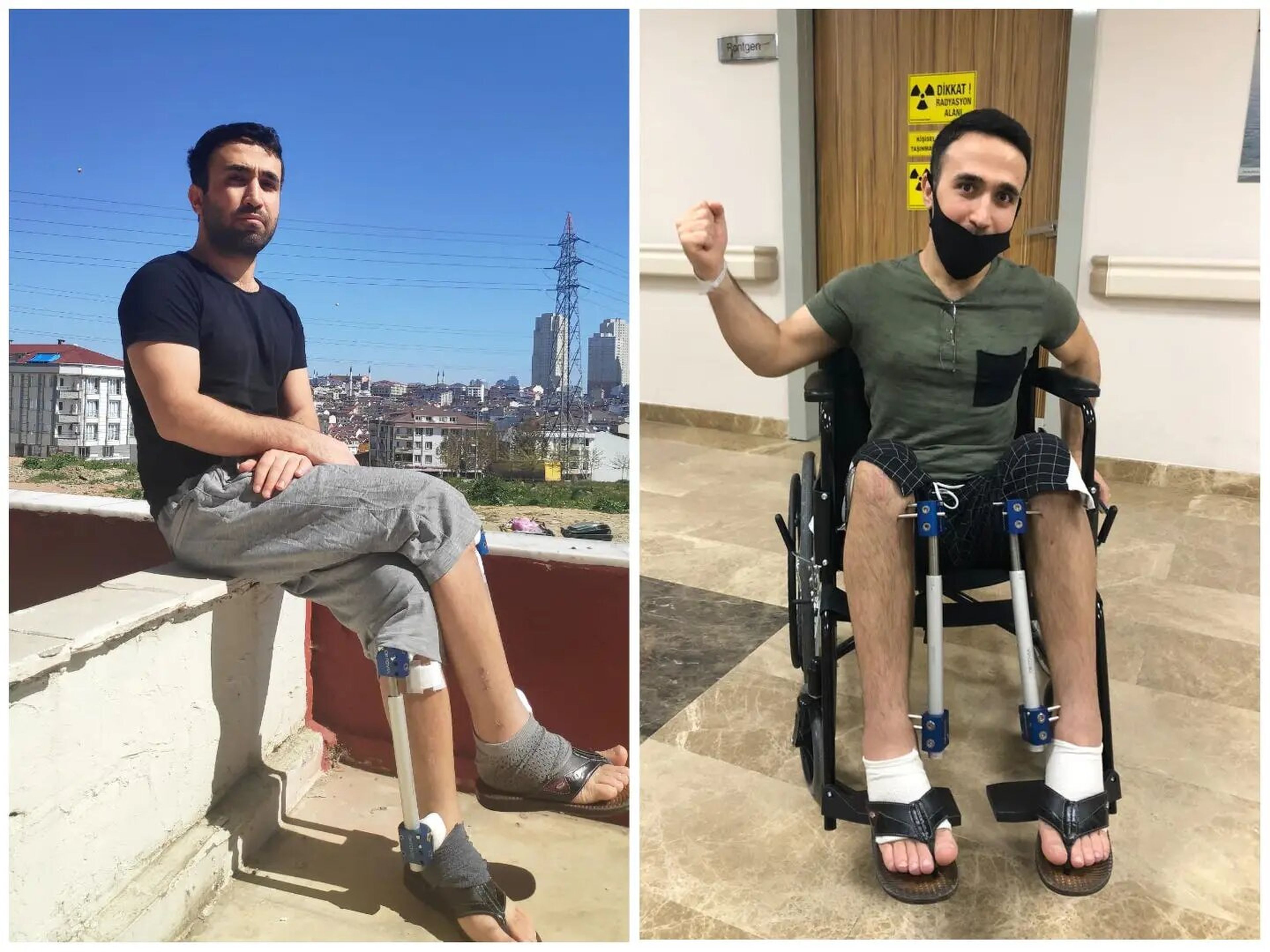 Ibrahim Alğan, en silla de ruedas tras la operación, a la derecha, y en el exterior tras una de sus operaciones. Pagó casi 27.000 dólares por una operación para alargar sus piernas.