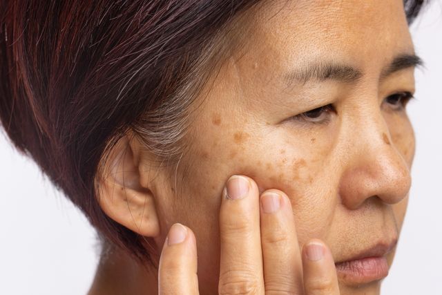 Melasma Y Létingos Solares Diferencias De Estas Manchas De La Piel