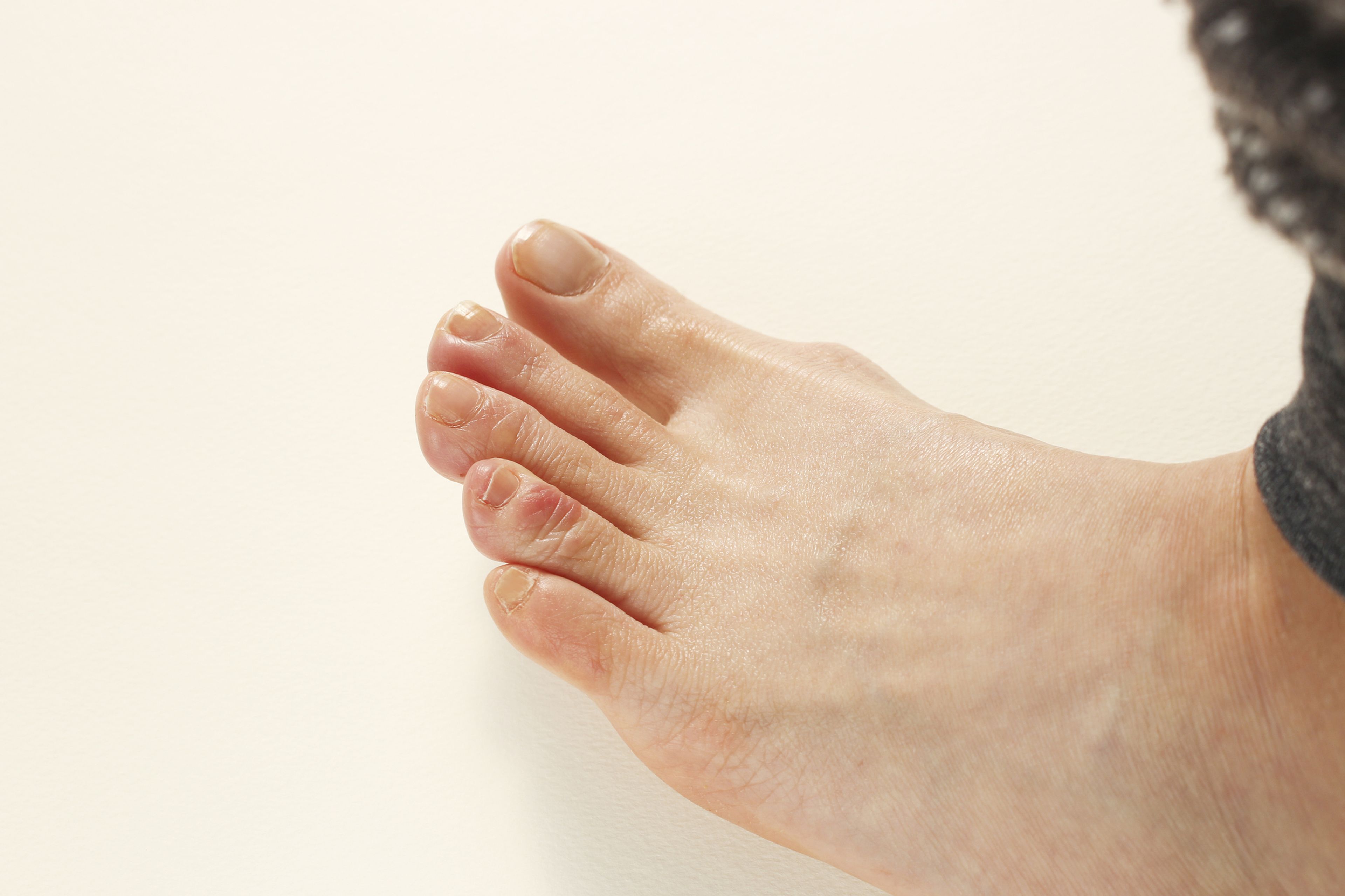 Dedos de los pies con sabañones