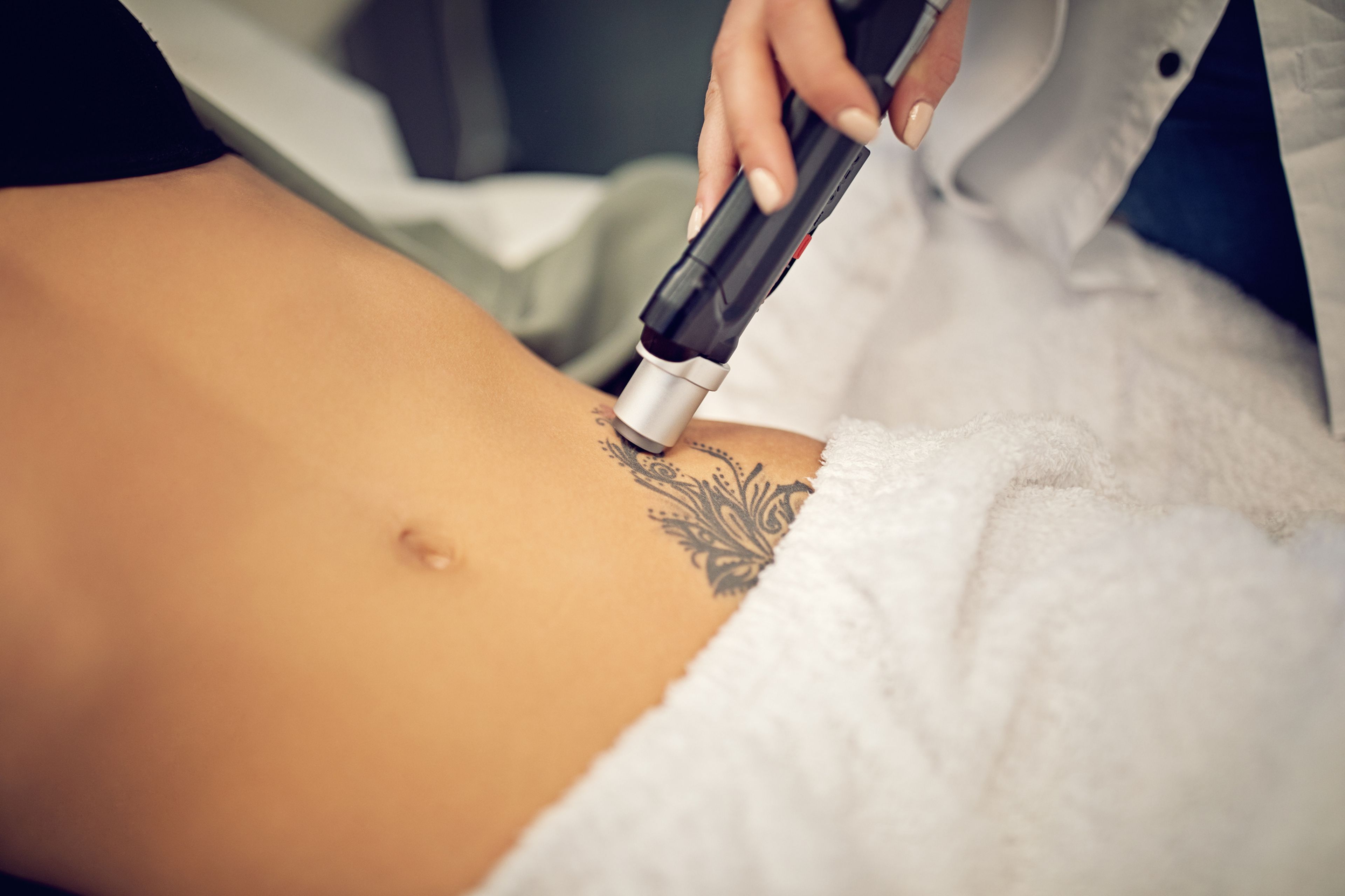 Eliminar un tatuaje con láser