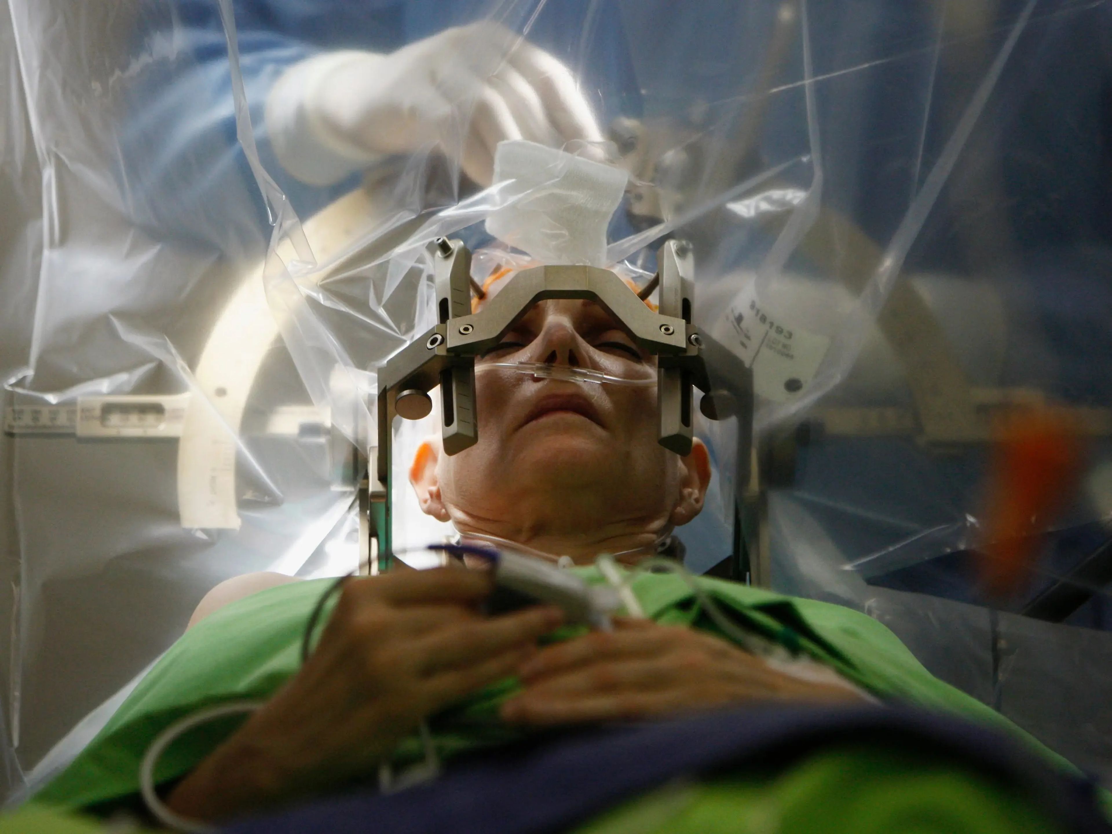 Una mujer se somete a una operación de estimulación cerebral profunda, un tipo de interfaz cerebro-ordenador que puede ayudar a las personas con enfermedad de Parkinson. 
