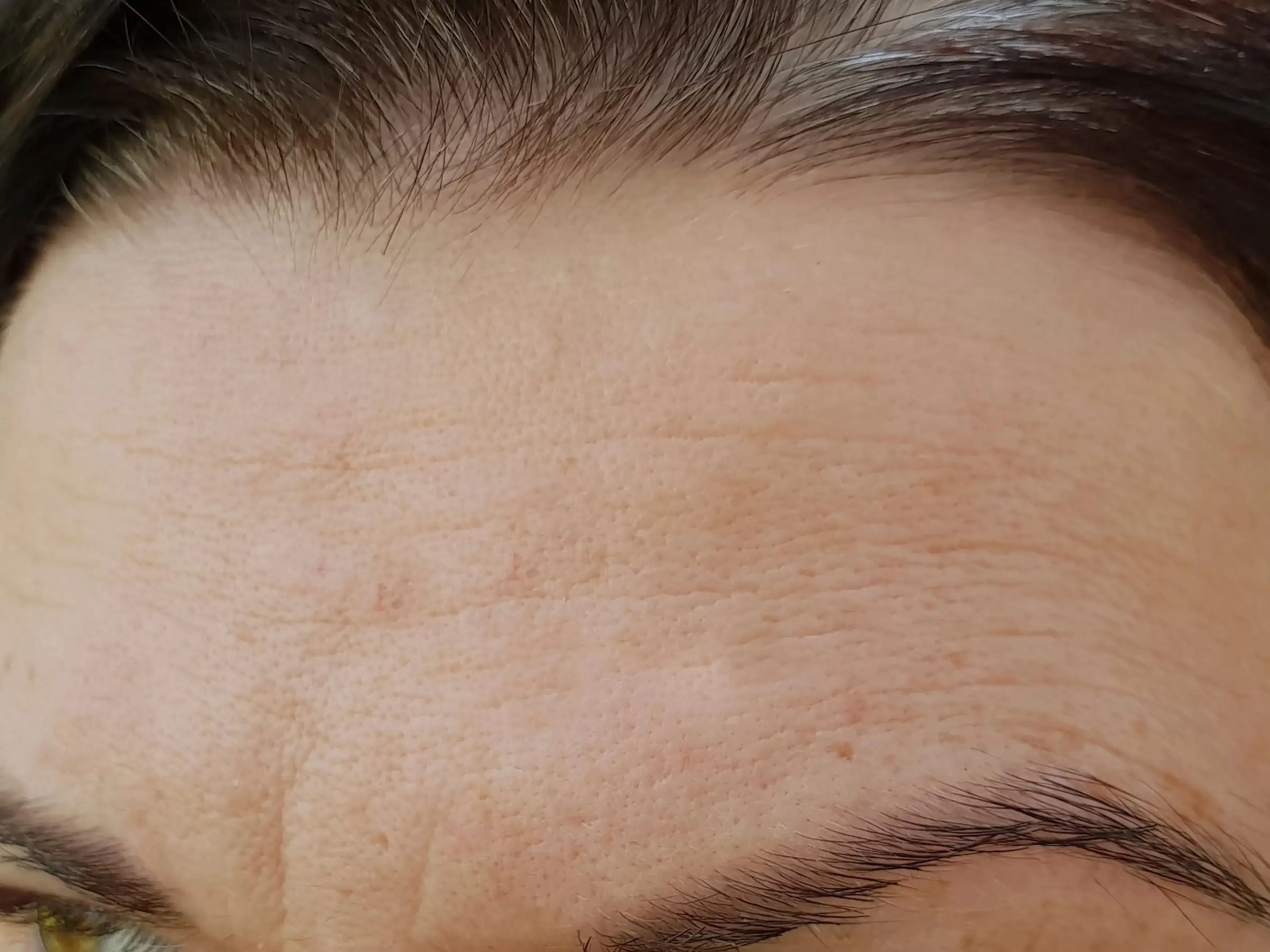 A woman's forehead with dehydration lines
