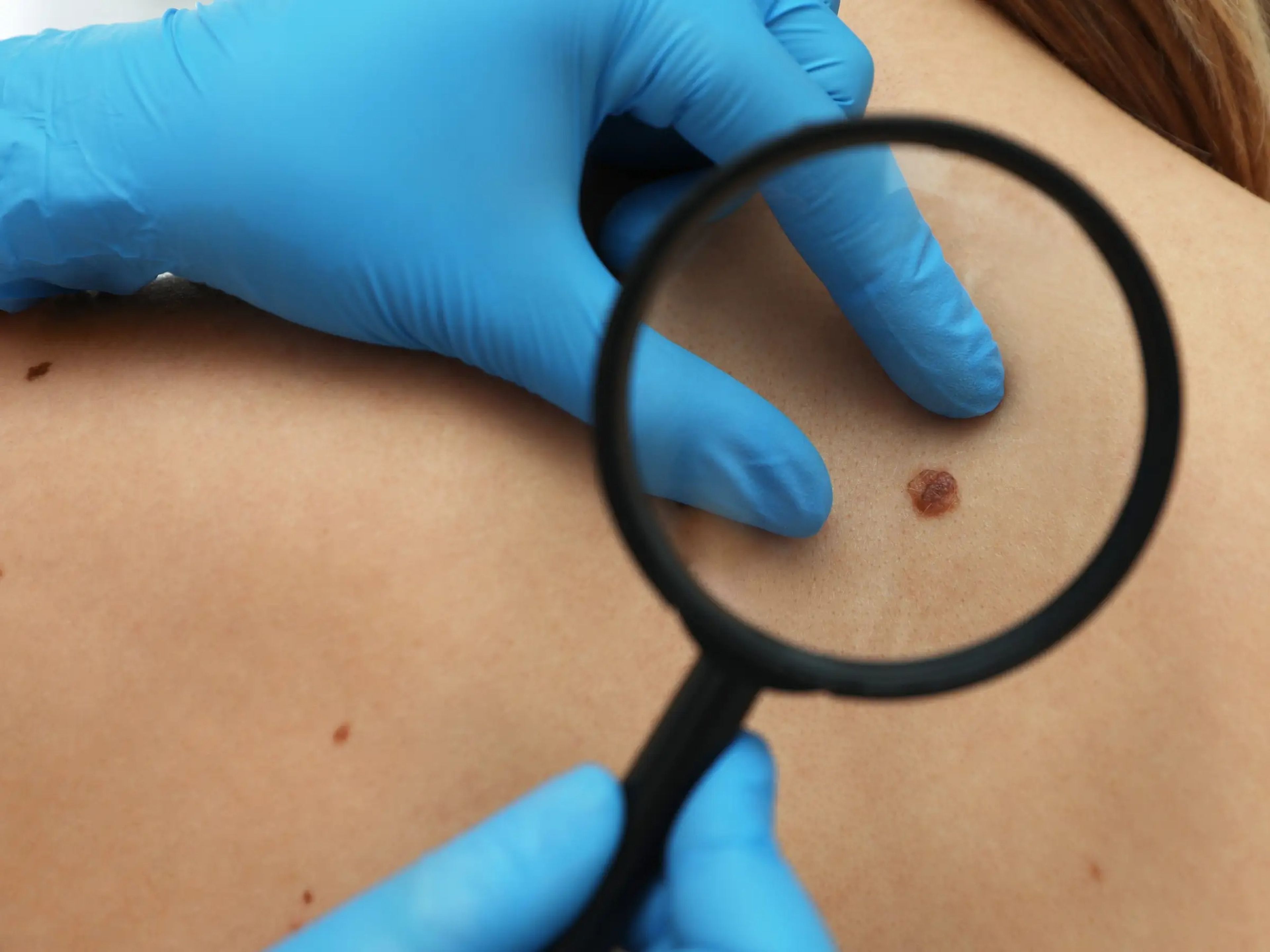 A doctor inspecting a mole for skin cancer